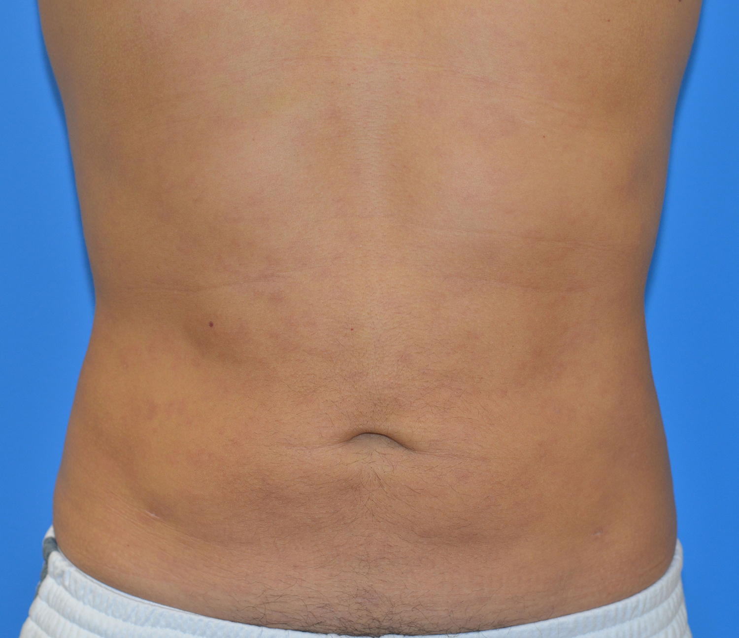After Image: Liposuction - front