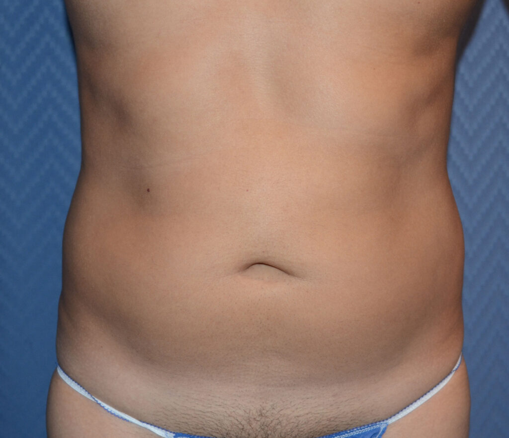 Before Image: Liposuction - front