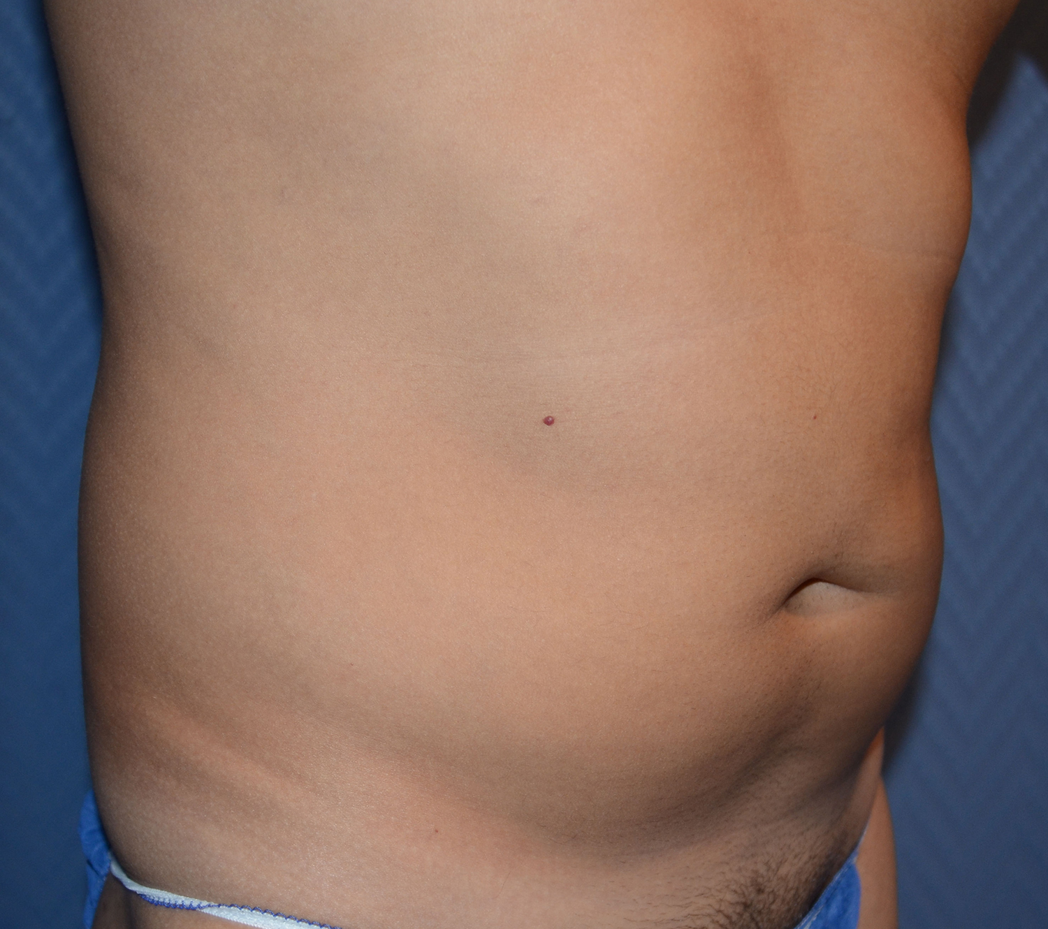 Before Image: Liposuction - right-front-oblique