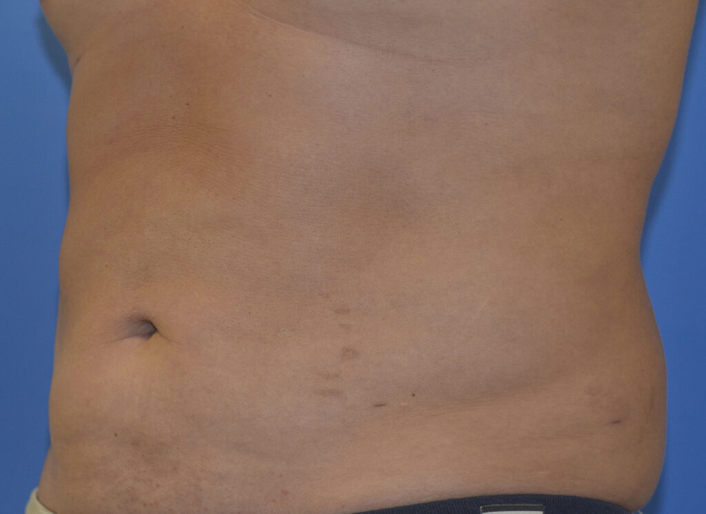 After Image: Liposuction - left-front-oblique