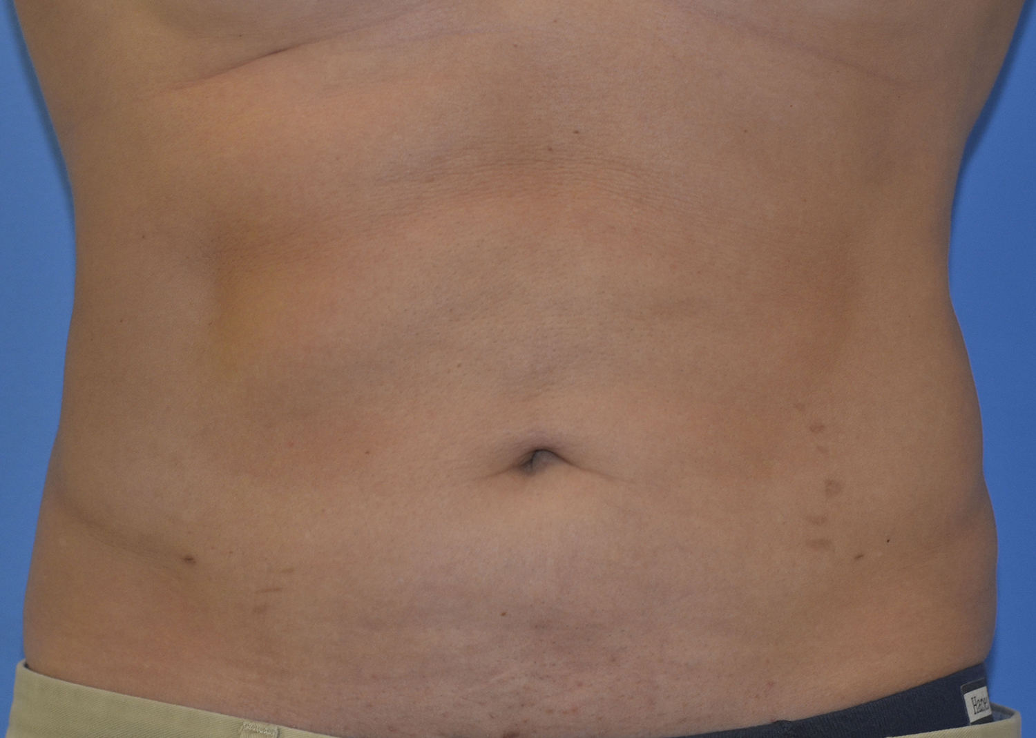 After Image: Liposuction - front
