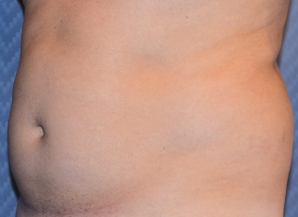 Before Image: Liposuction - left-front-oblique