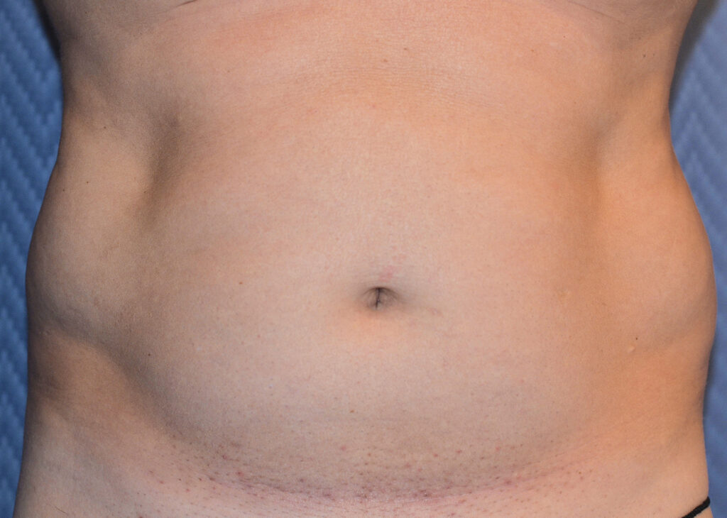 Before Image: Liposuction - front