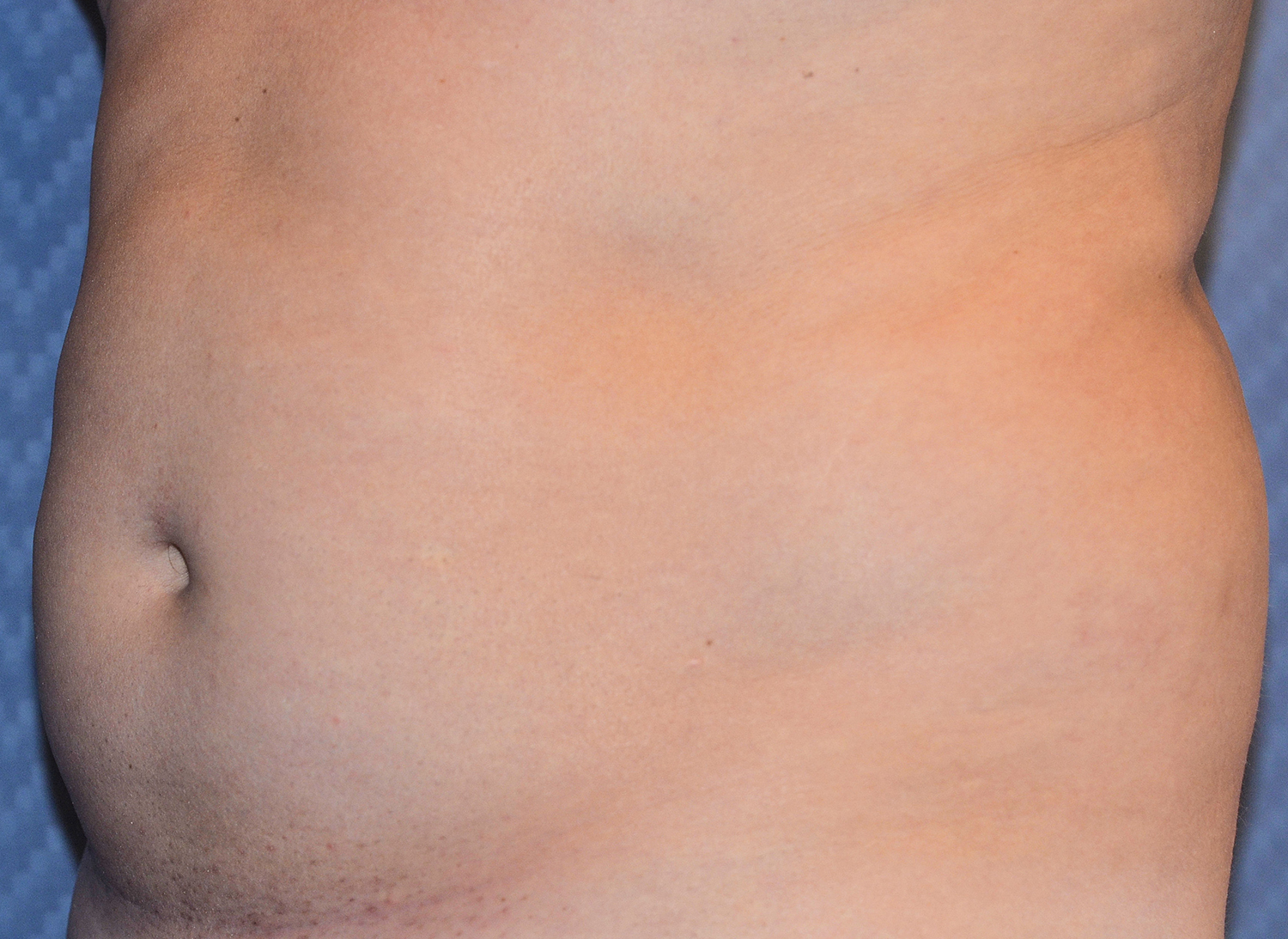 Before Image: Liposuction - left-front-oblique