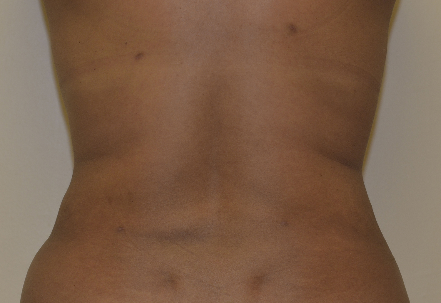 After Image: Liposuction - back