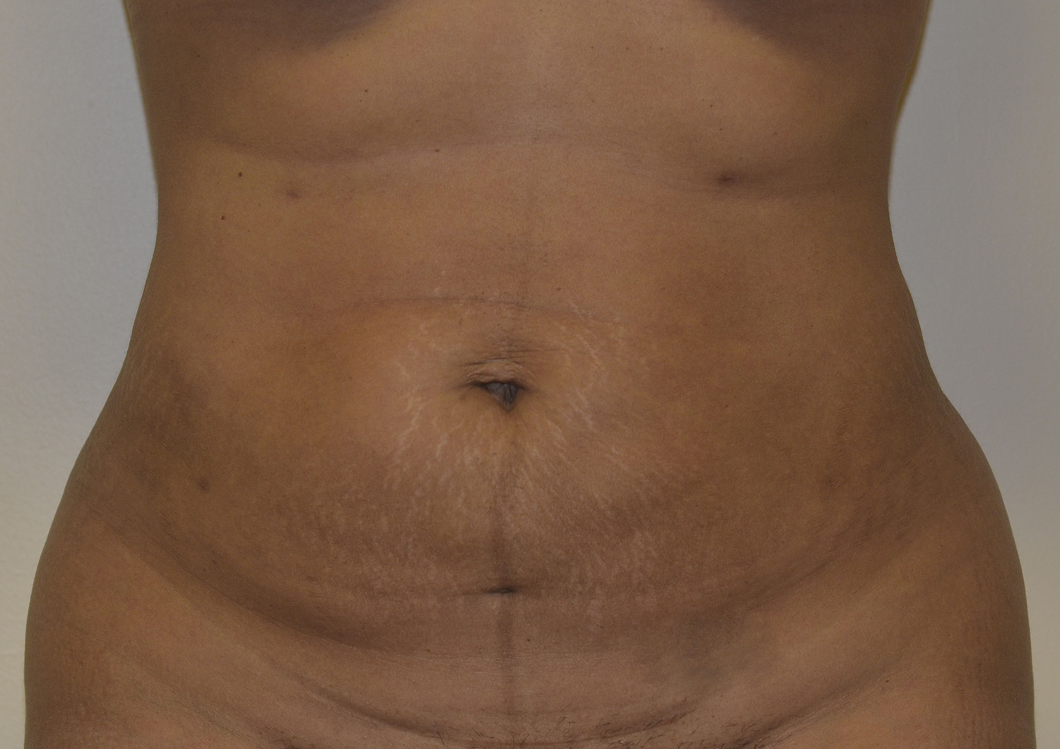After Image: Liposuction - front