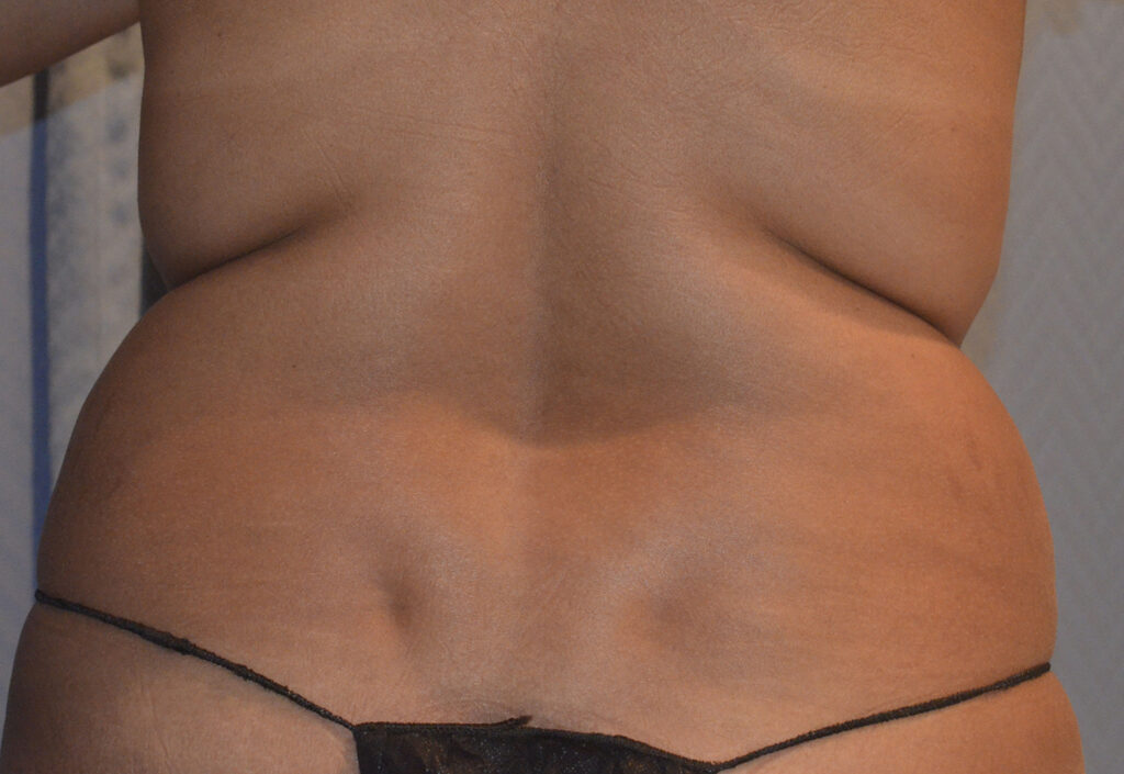 Before Image: Liposuction - back