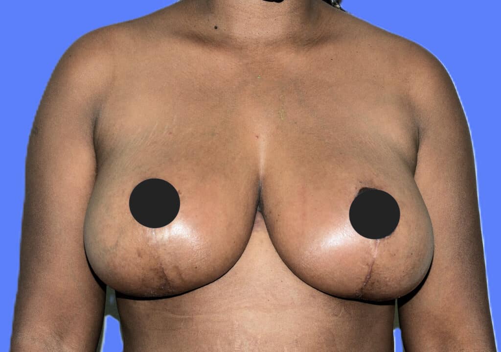 After Image: Mastopexy - front