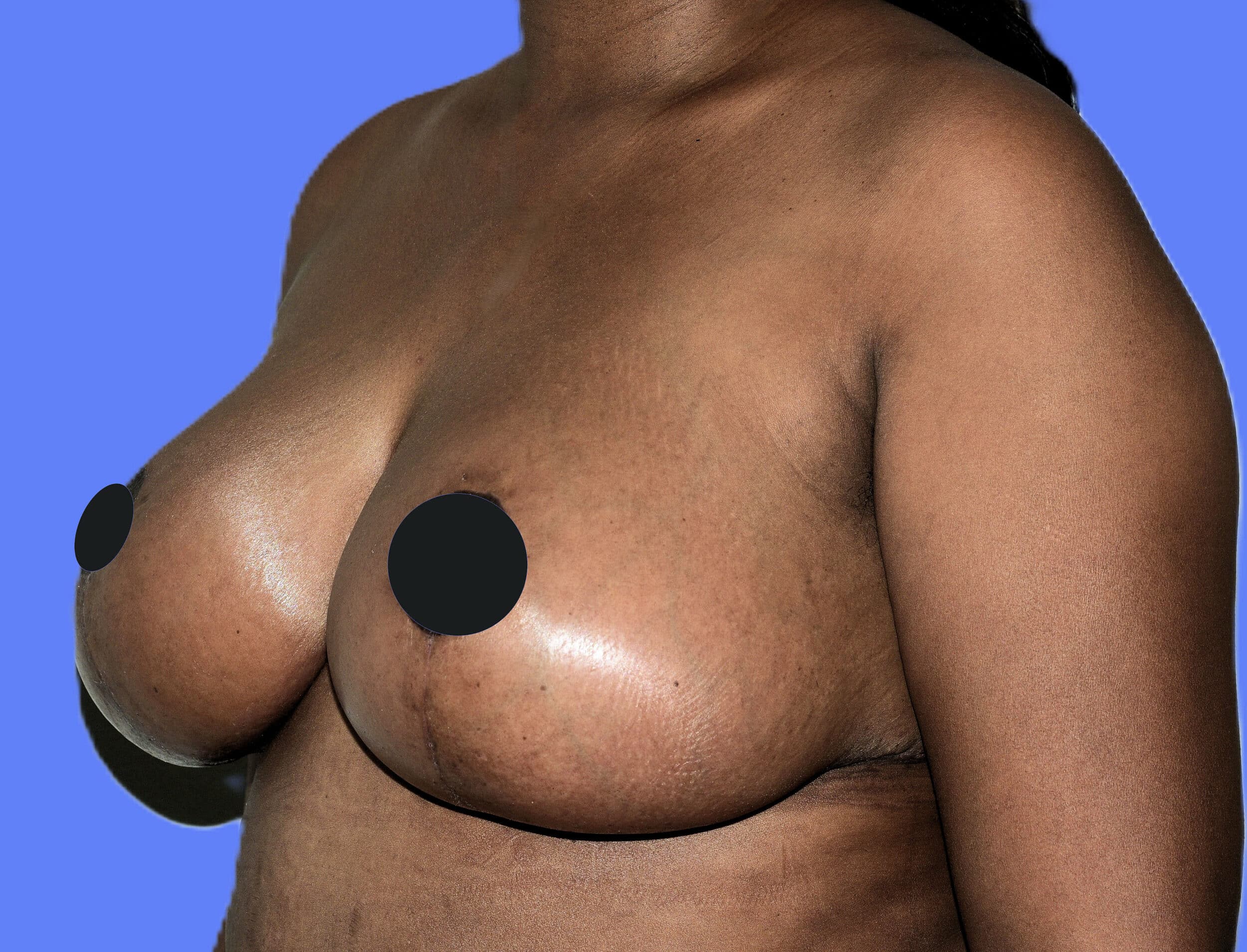 After Image: Mastopexy - left-front-oblique