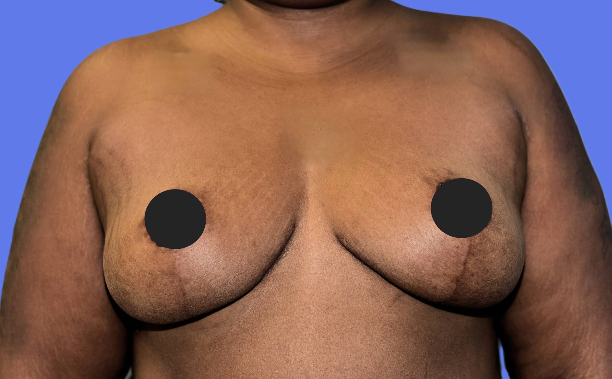 After Image: Breast Lift (Mastopexy) - front