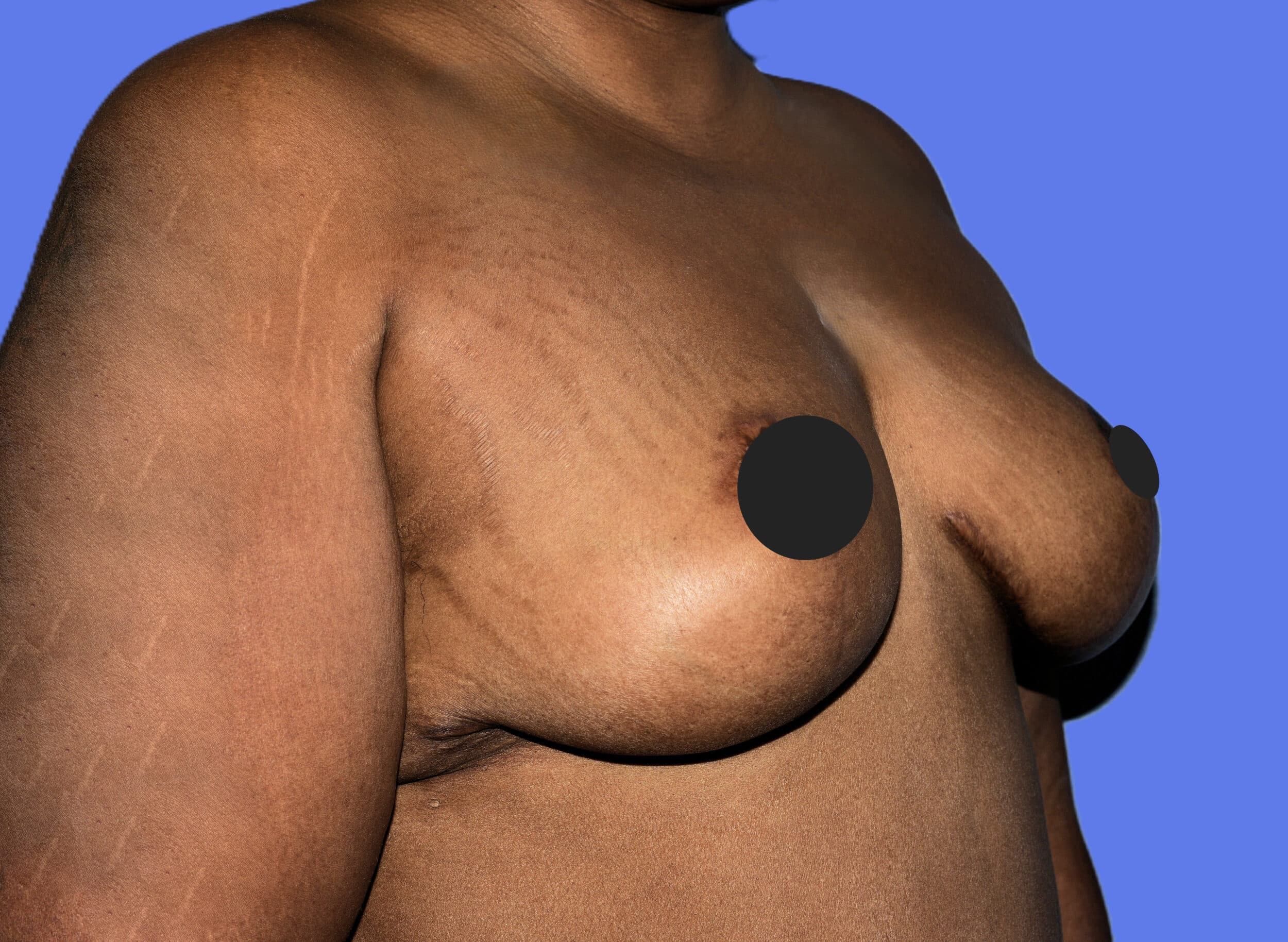 After Image: Breast Lift (Mastopexy) - right-front-oblique