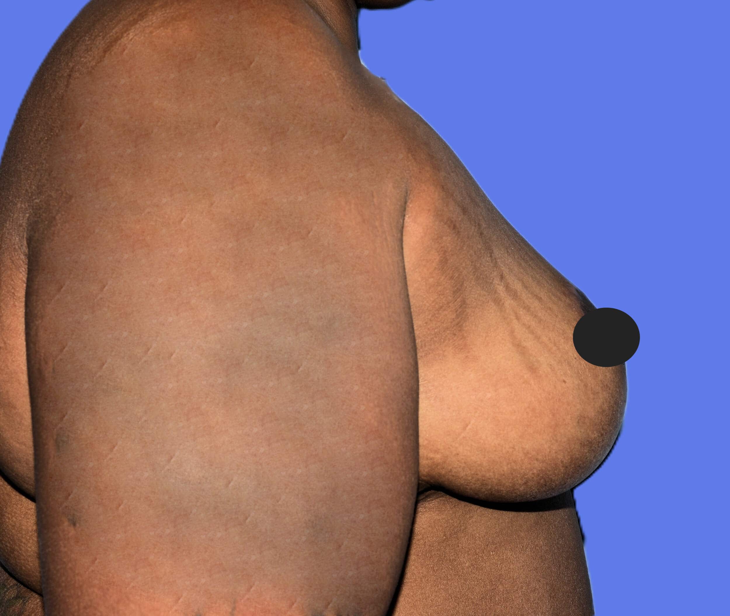 After Image: Breast Lift (Mastopexy) - right-side