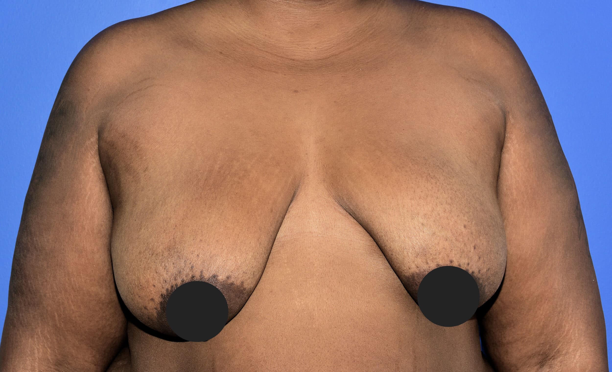 Before Image: Breast Lift (Mastopexy) - front