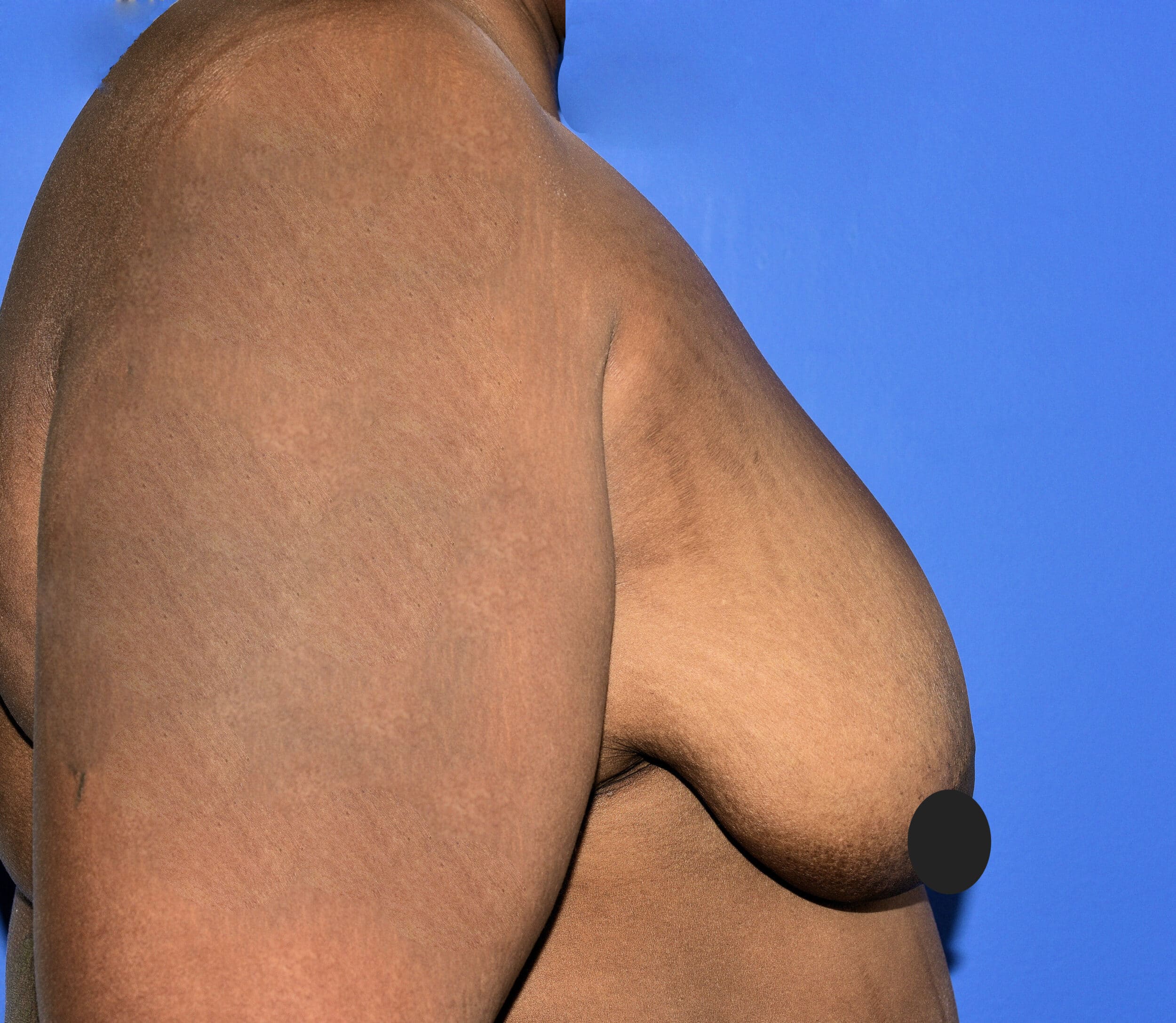 Before Image: Breast Lift (Mastopexy) - right-side