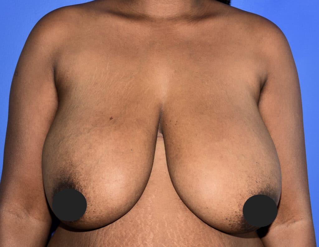 Before Image: Mastopexy - front