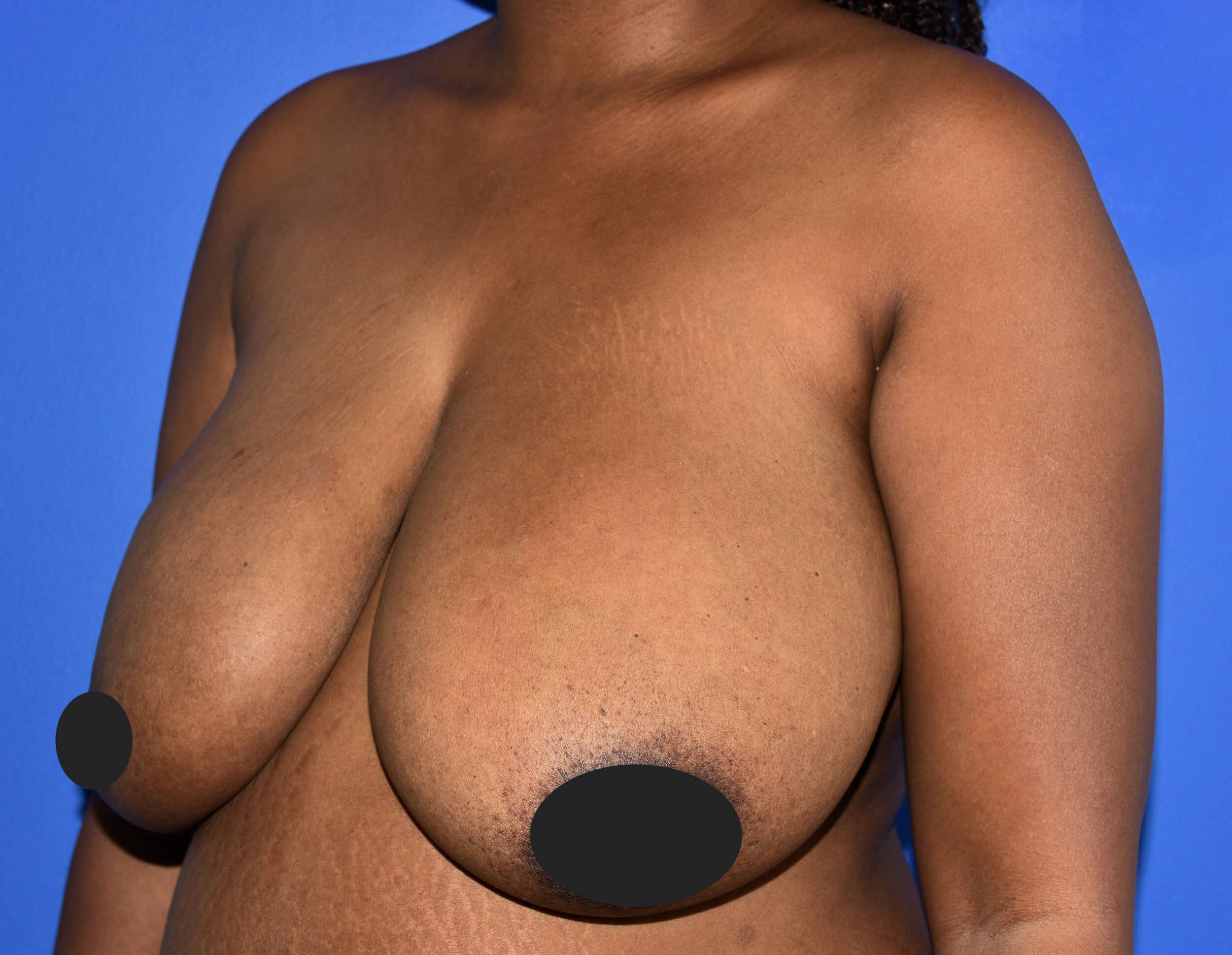 Before Image: Mastopexy - left-front-oblique