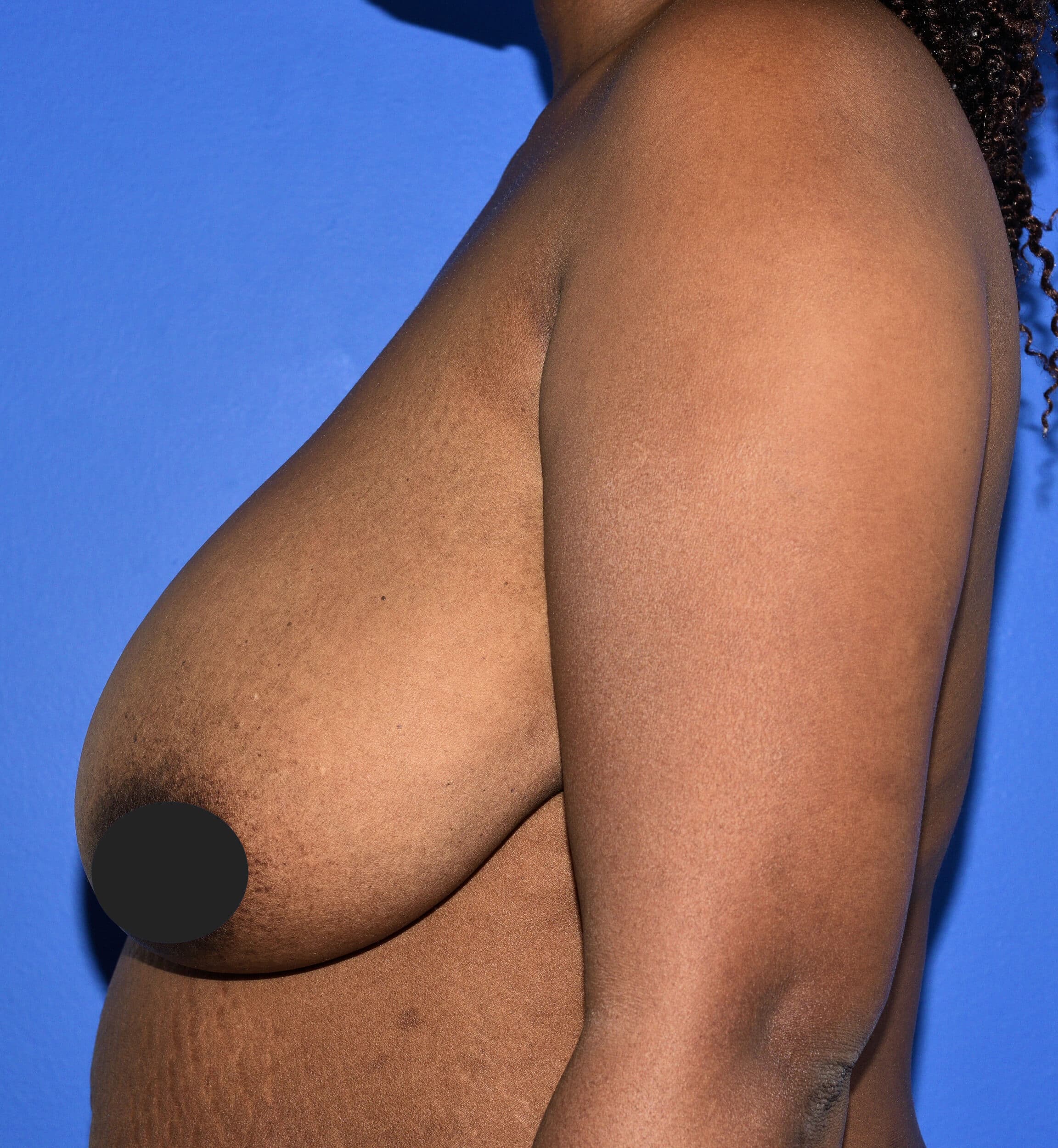 Before Image: Mastopexy - left-side
