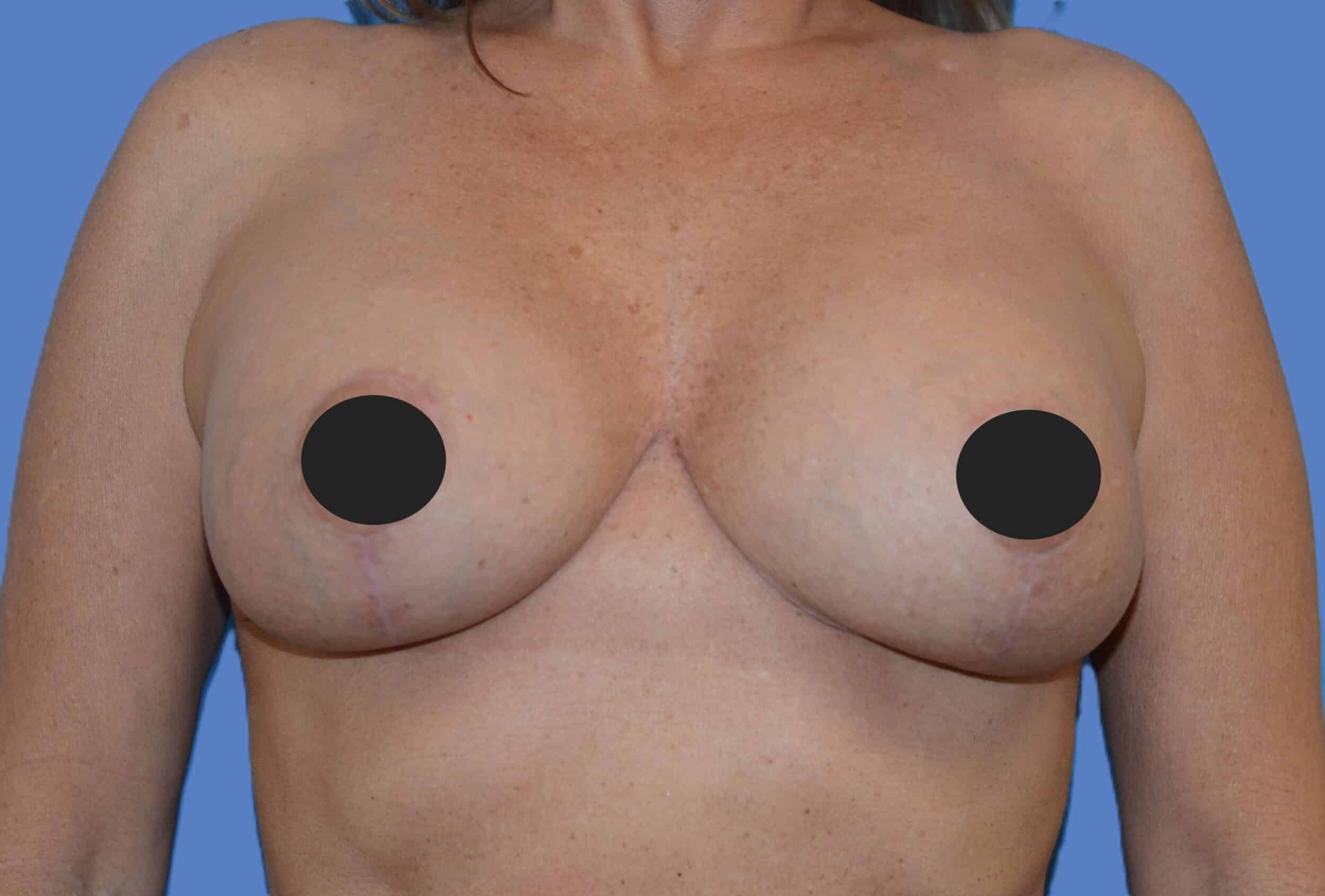 After Image: Breast Reaugmentation and Lift - front