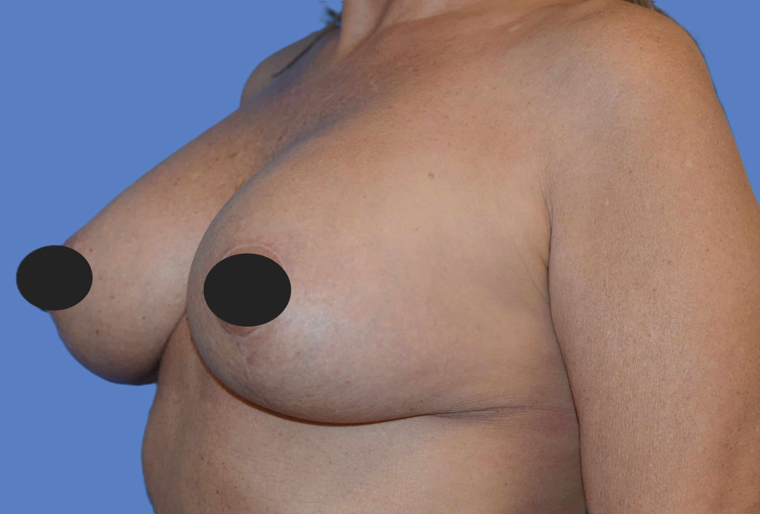 After Image: Breast Reaugmentation and Lift - left-front-oblique