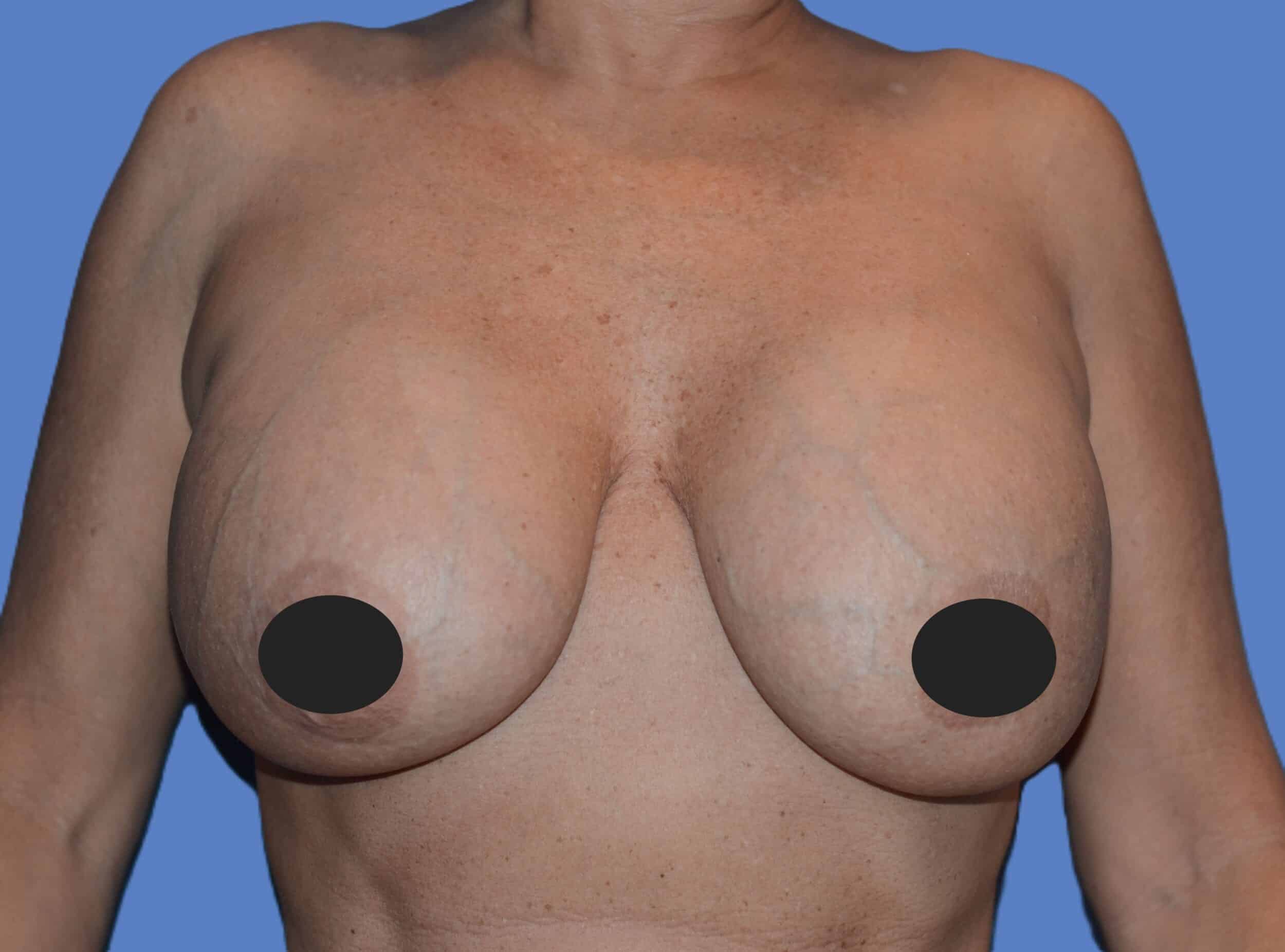 Before Image: Breast Reaugmentation and Lift - front