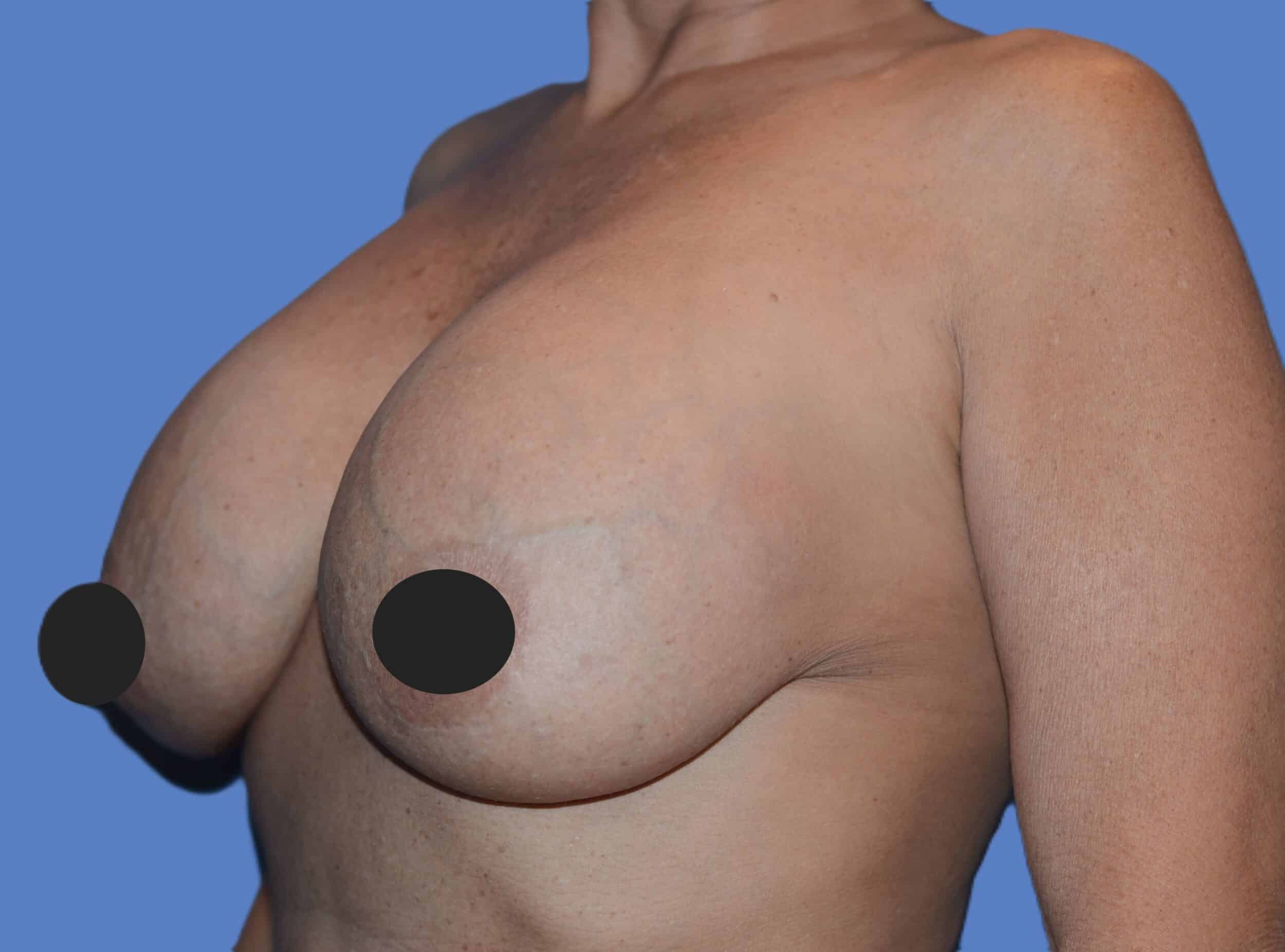Before Image: Breast Reaugmentation and Lift - left-front-oblique