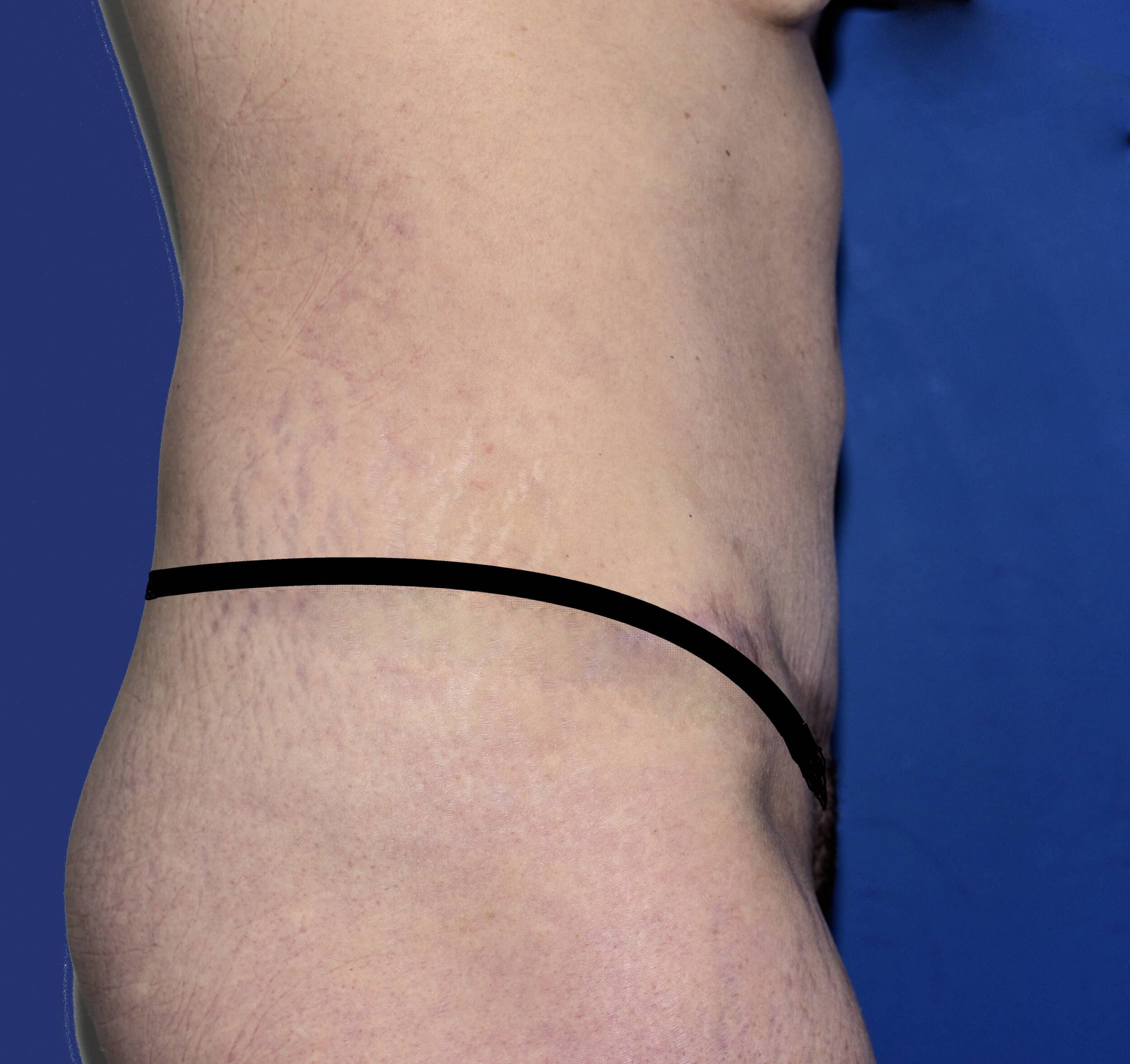 After Image: Tummy Tuck - right-side