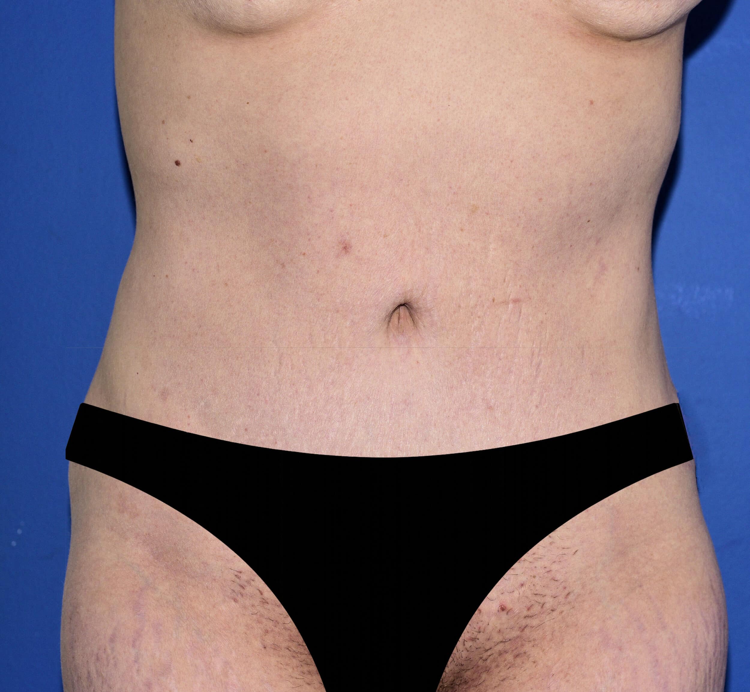 After Image: Tummy Tuck - front