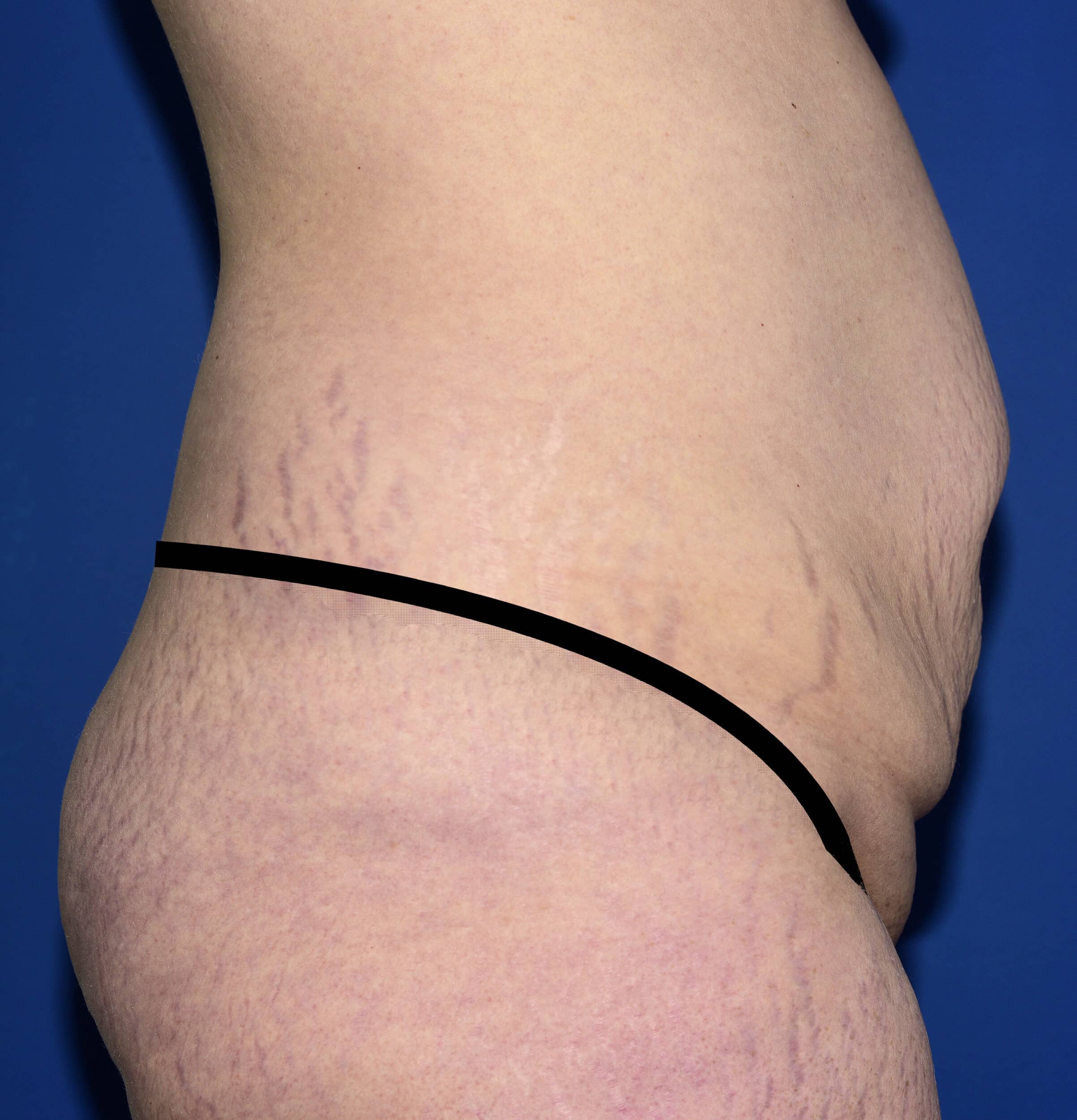 Before Image: Tummy Tuck - right-side