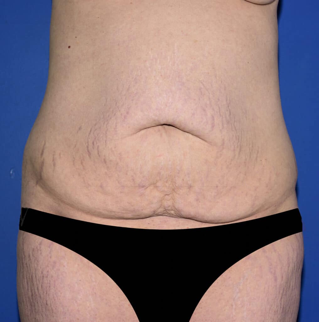 Before Image: Tummy Tuck - front