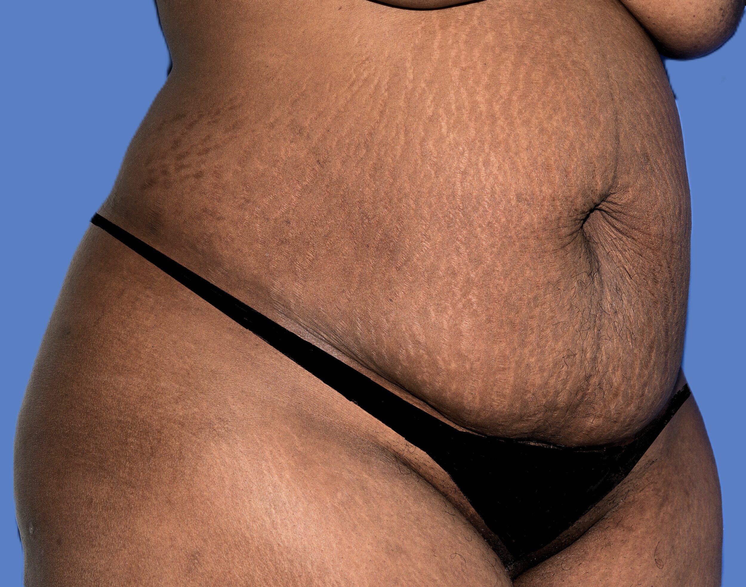 Before Image: Tummy Tuck - right-front-oblique