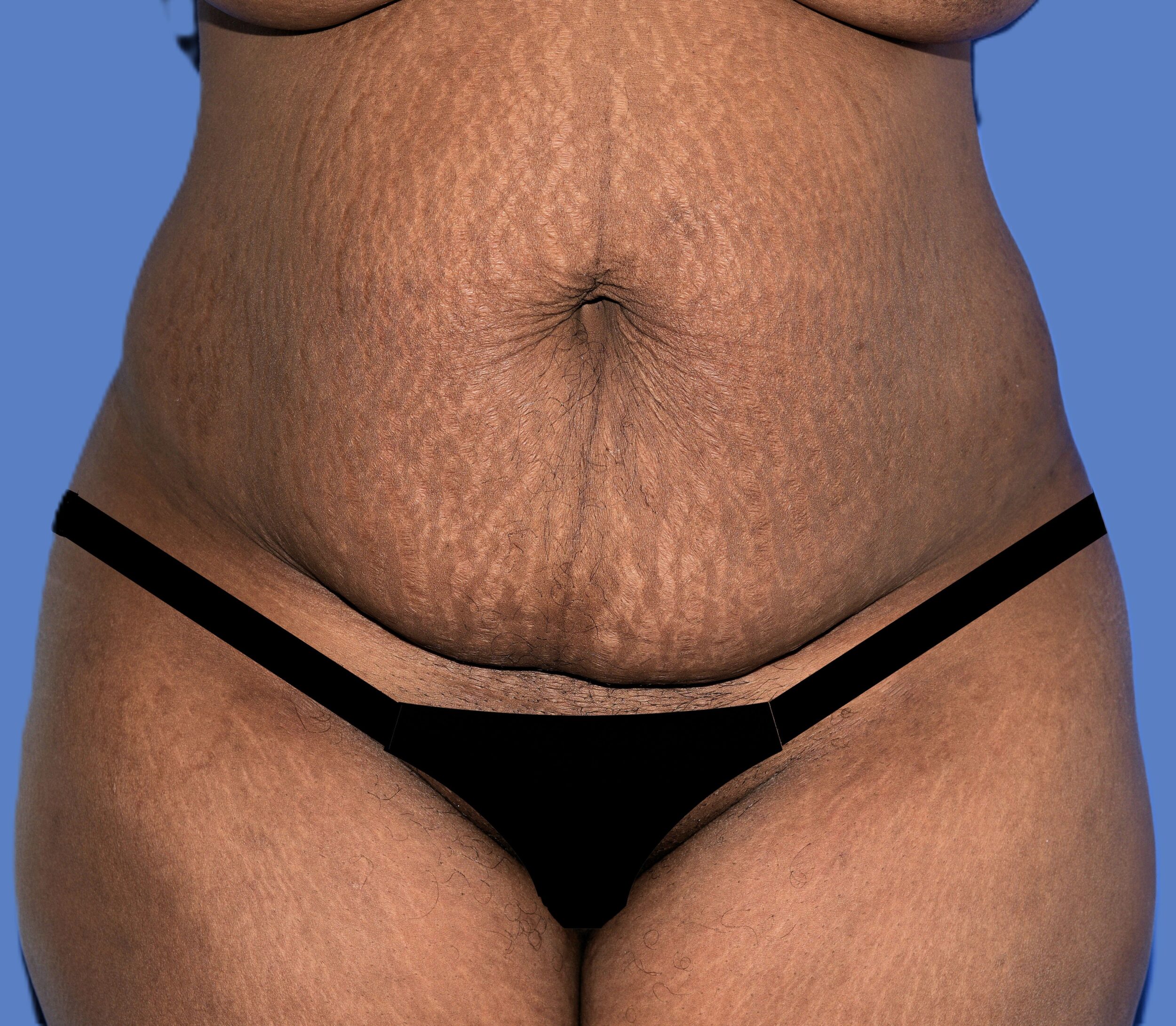Before Image: Tummy Tuck - front
