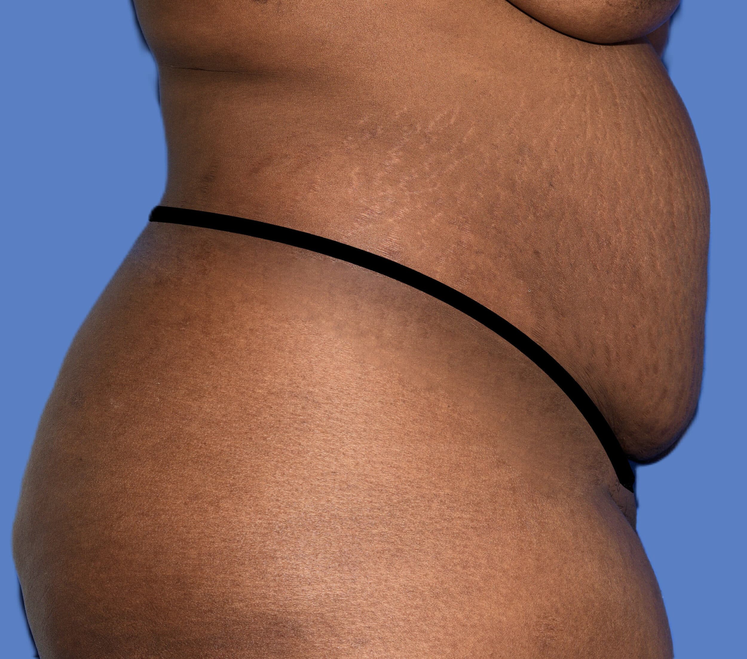 Before Image: Tummy Tuck - right-side