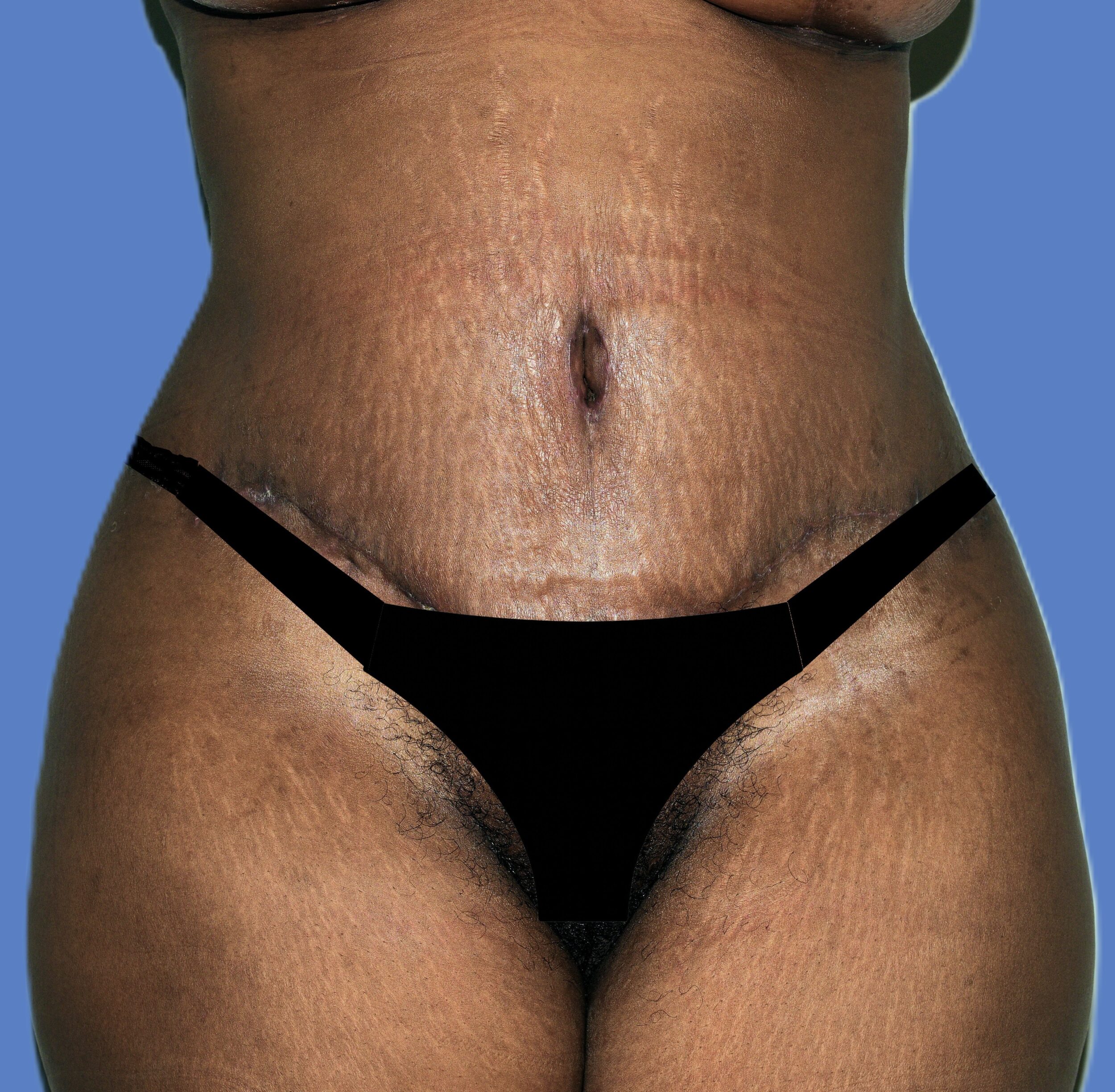 After Image: Tummy Tuck - front
