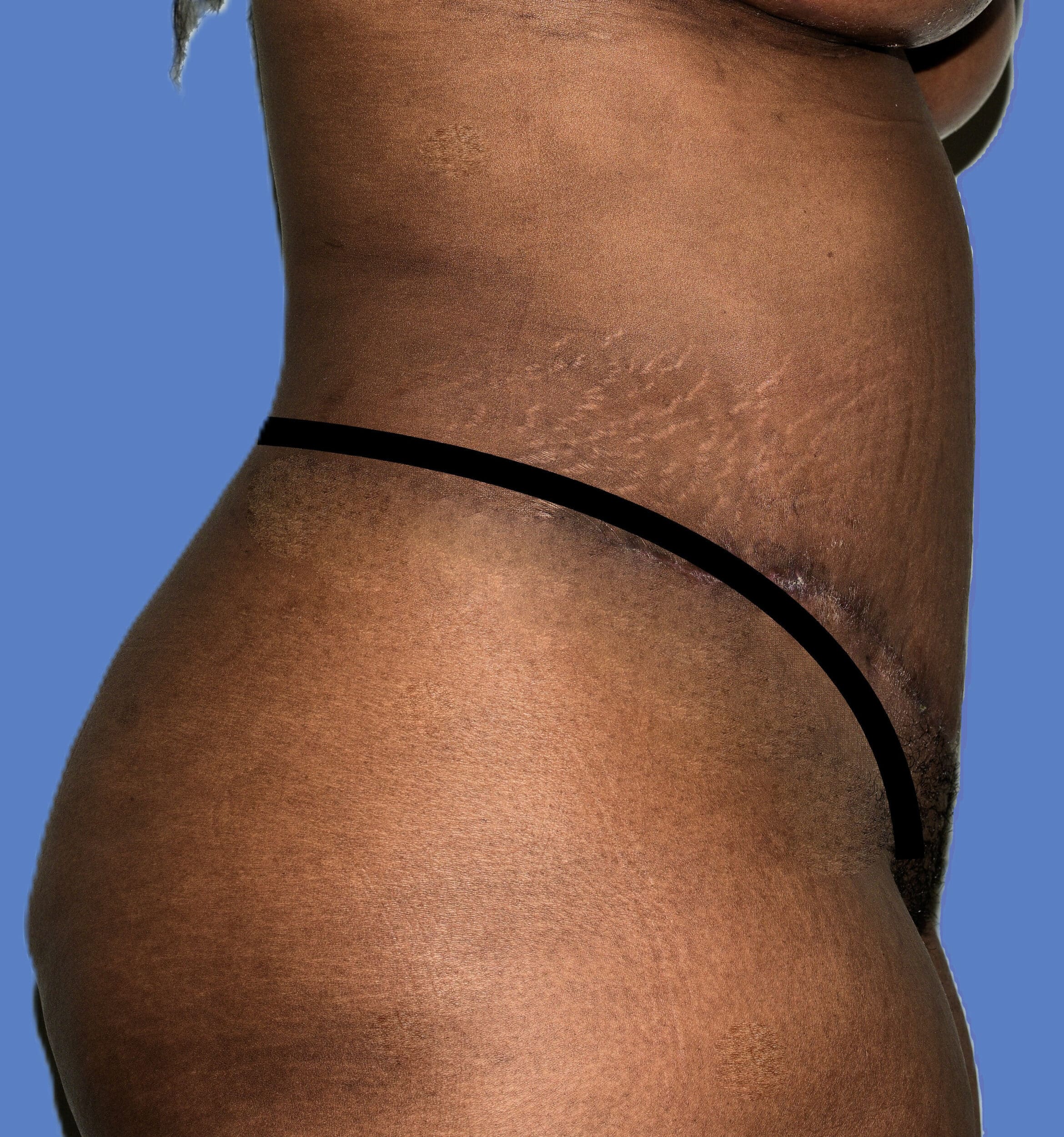 After Image: Tummy Tuck - right-side
