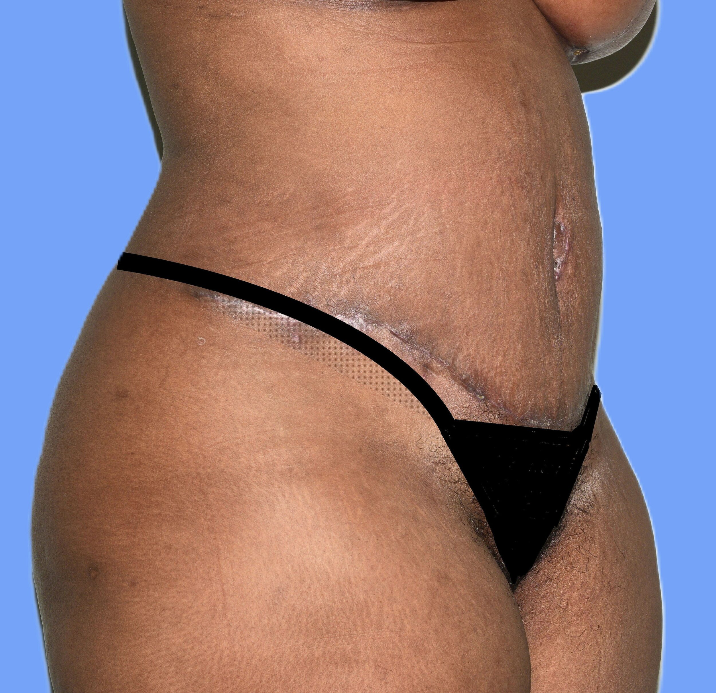 After Image: Tummy Tuck - right-front-oblique