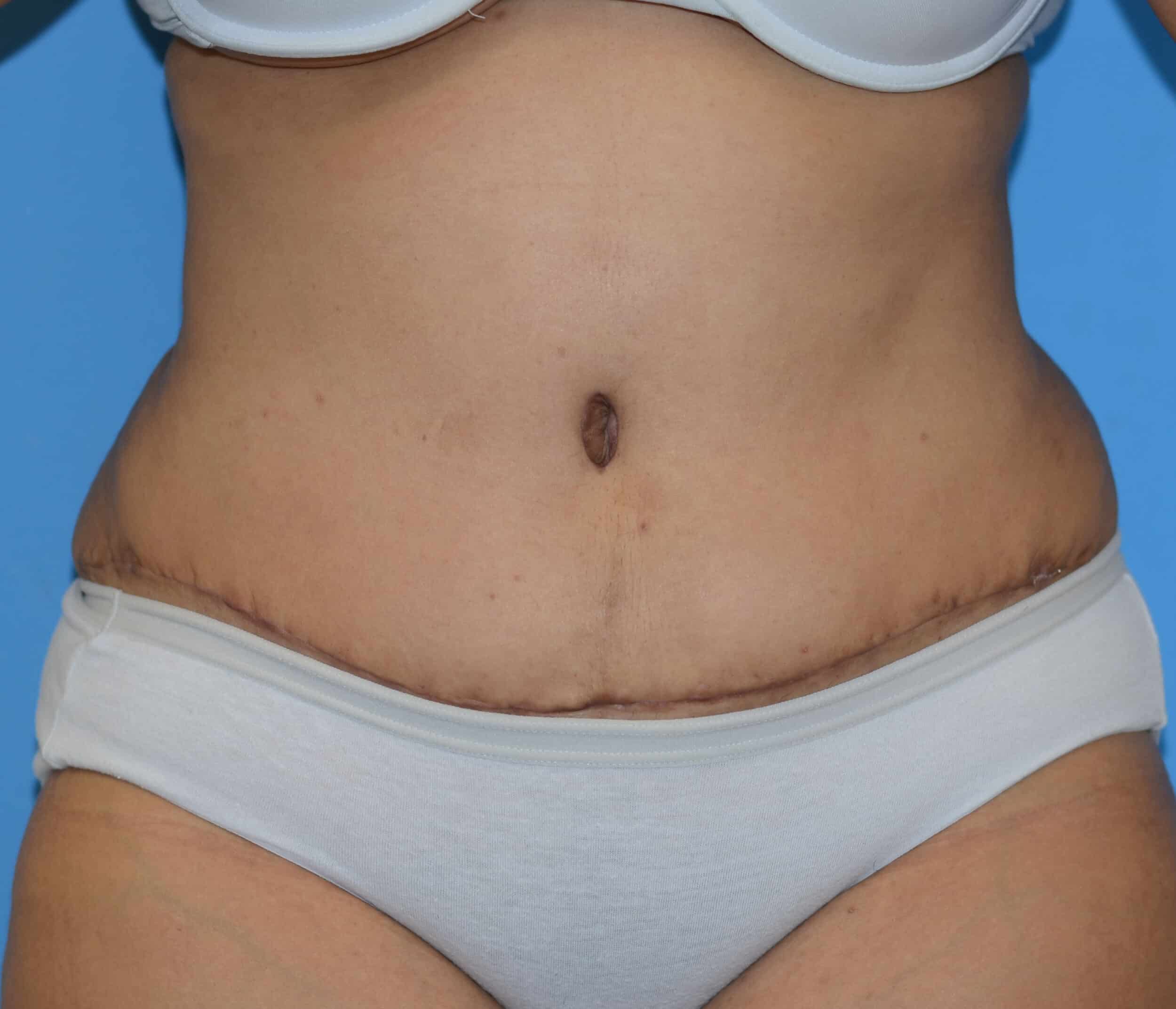 After Image: Tummy Tuck with Hernia Repair - front