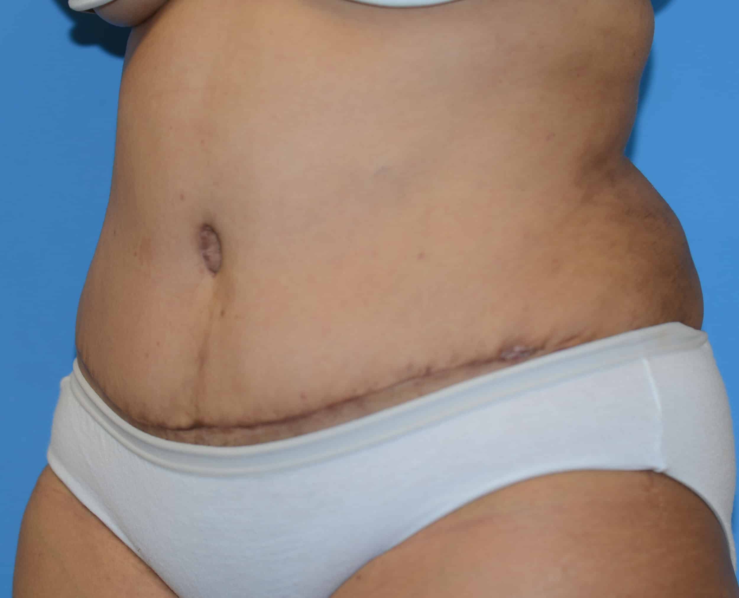 After Image: Tummy Tuck with Hernia Repair - left-front-oblique