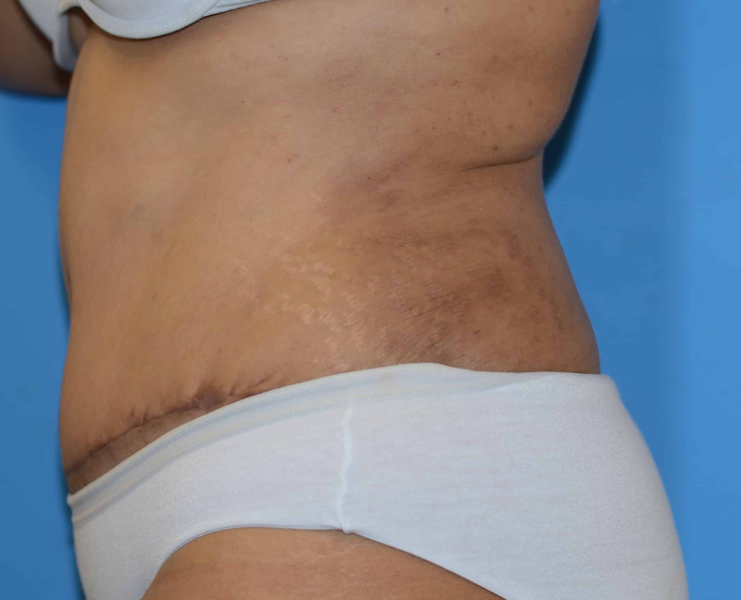 After Image: Tummy Tuck with Hernia Repair - left-side