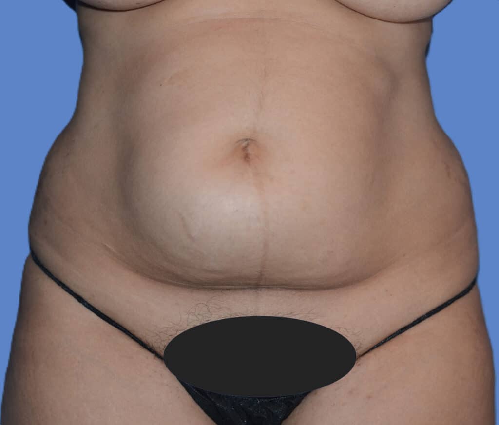 Before Image: Tummy Tuck with Hernia Repair - front