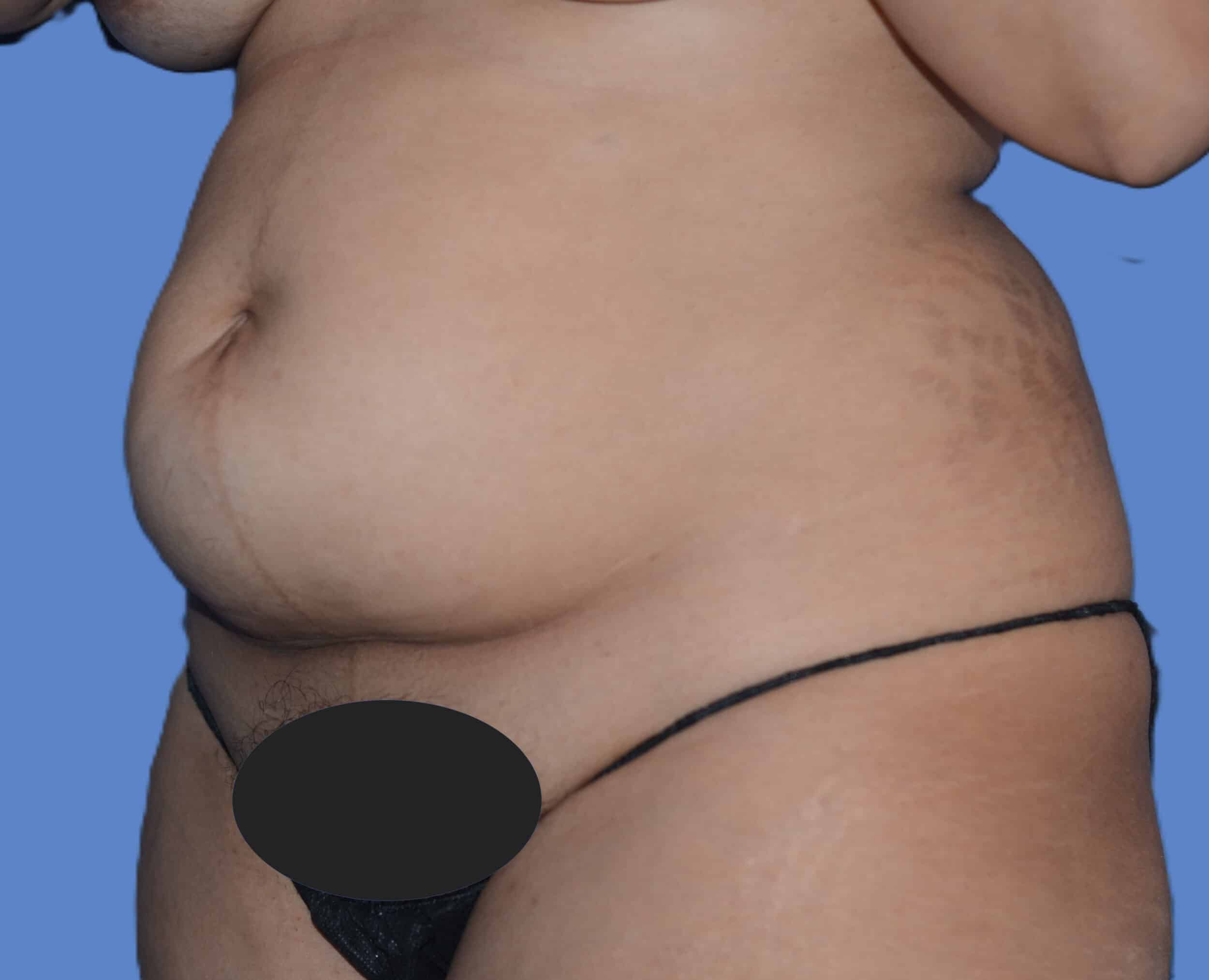 Before Image: Tummy Tuck with Hernia Repair - left-front-oblique