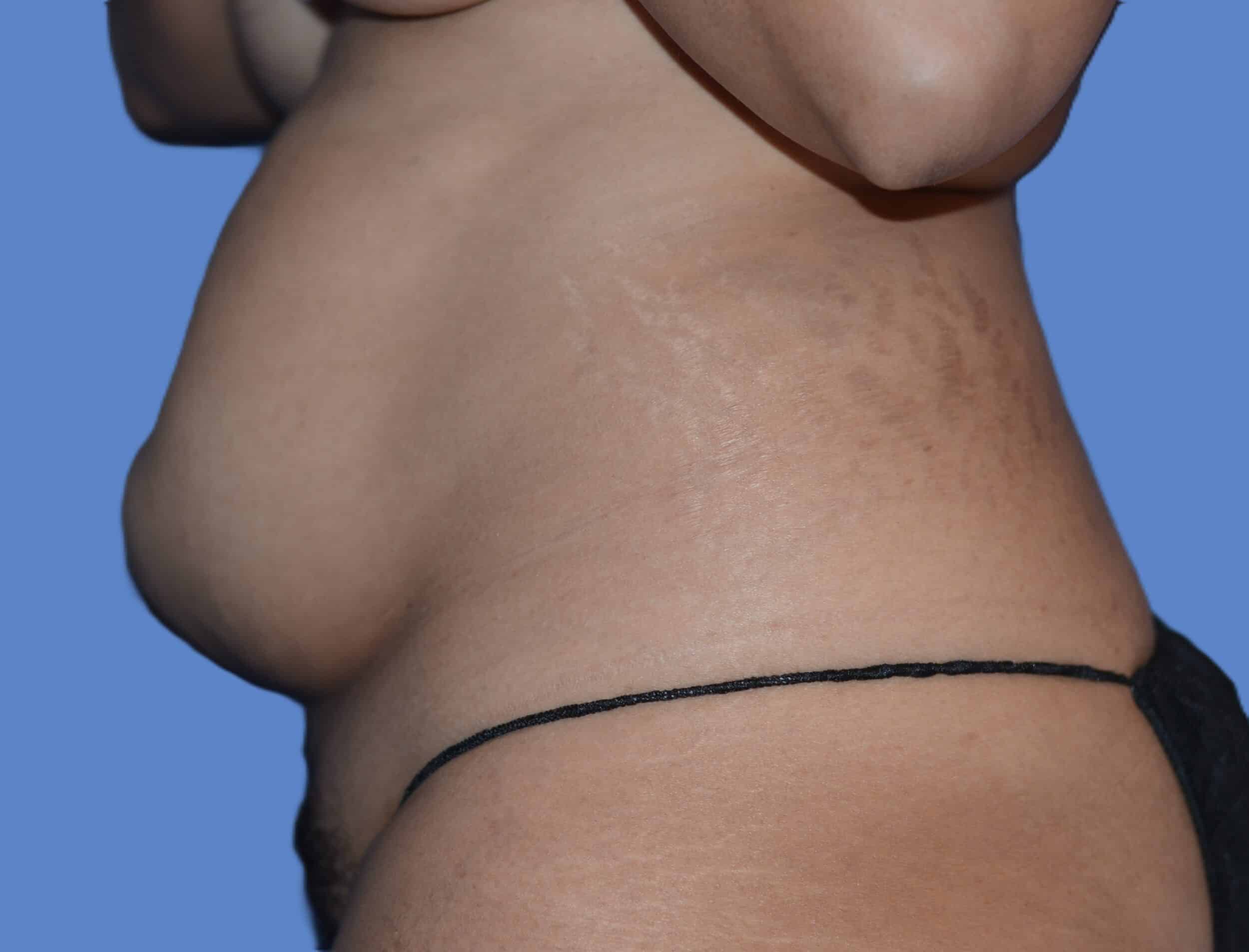 Before Image: Tummy Tuck with Hernia Repair - left-side