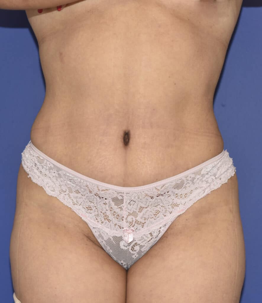 After Image: Tummy Tuck, Lower Vertical Scar Removal - front