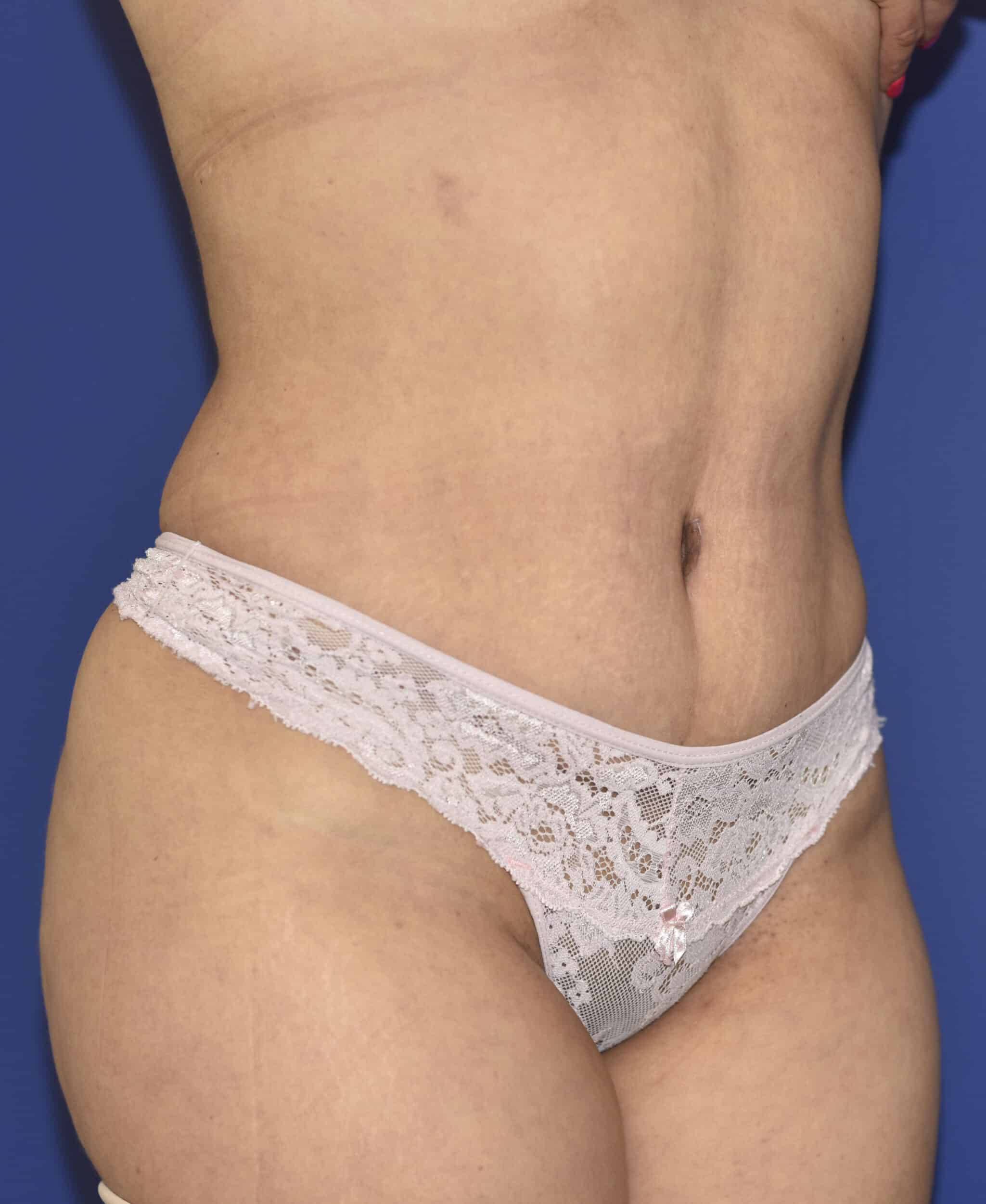 After Image: Tummy Tuck, Lower Vertical Scar Removal - right-front-oblique