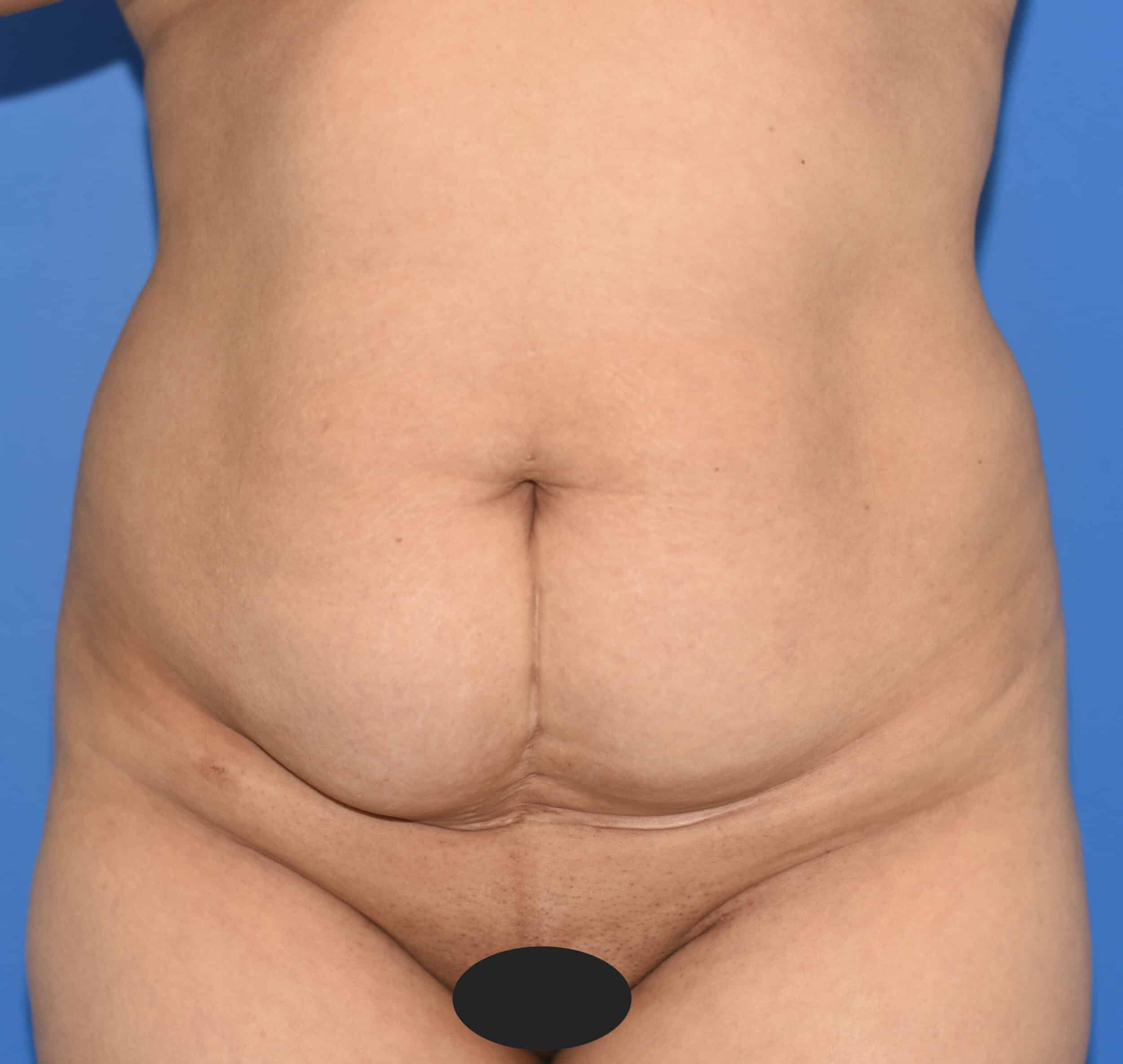 Before Image: Tummy Tuck, Lower Vertical Scar Removal - front
