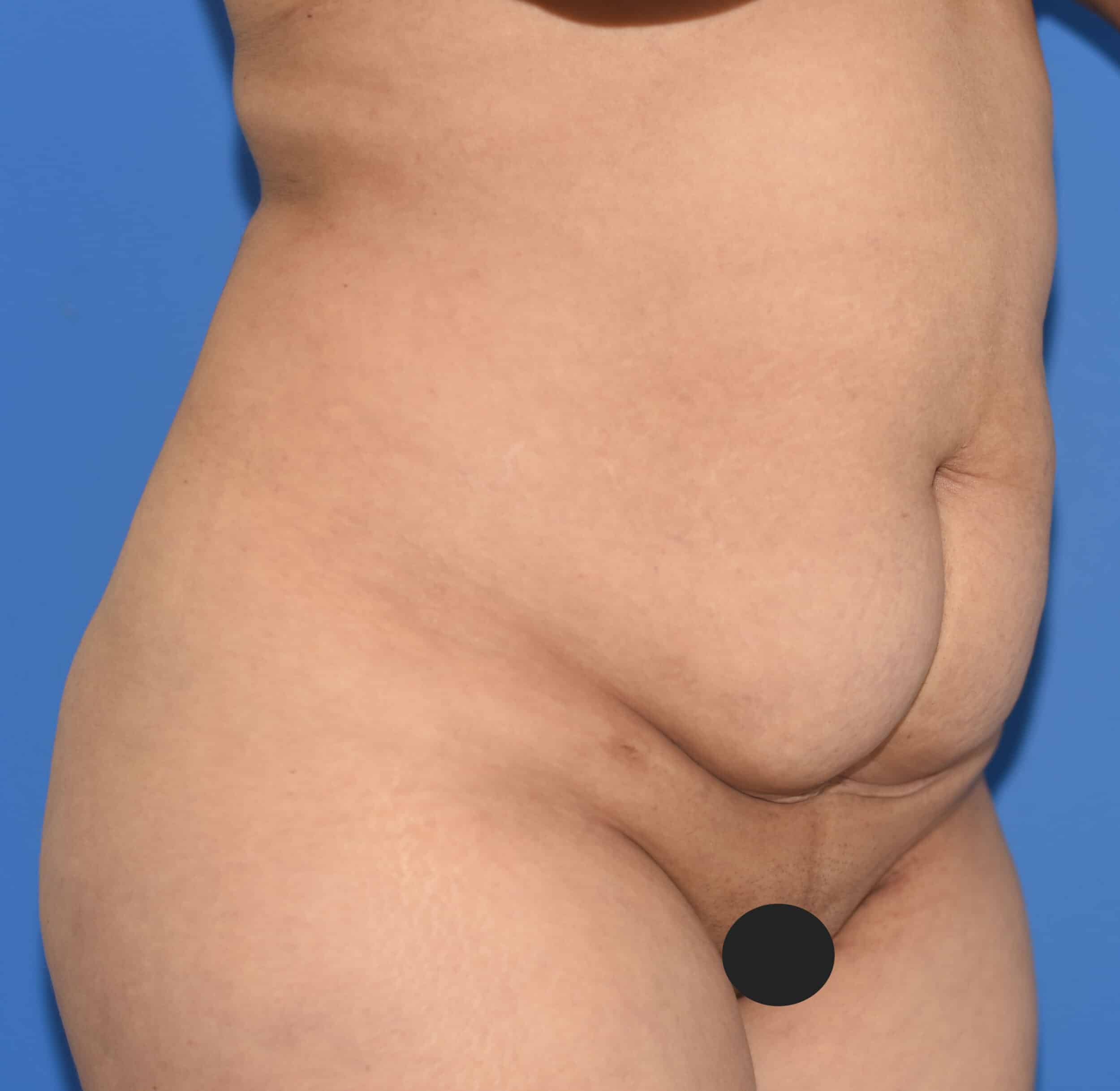 Before Image: Tummy Tuck, Lower Vertical Scar Removal - right-front-oblique