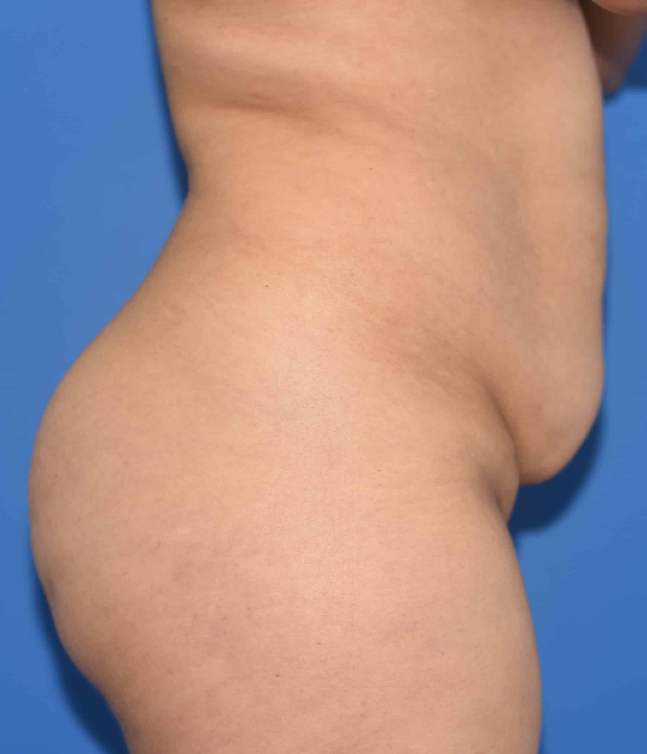 Before Image: Tummy Tuck, Lower Vertical Scar Removal - right-side