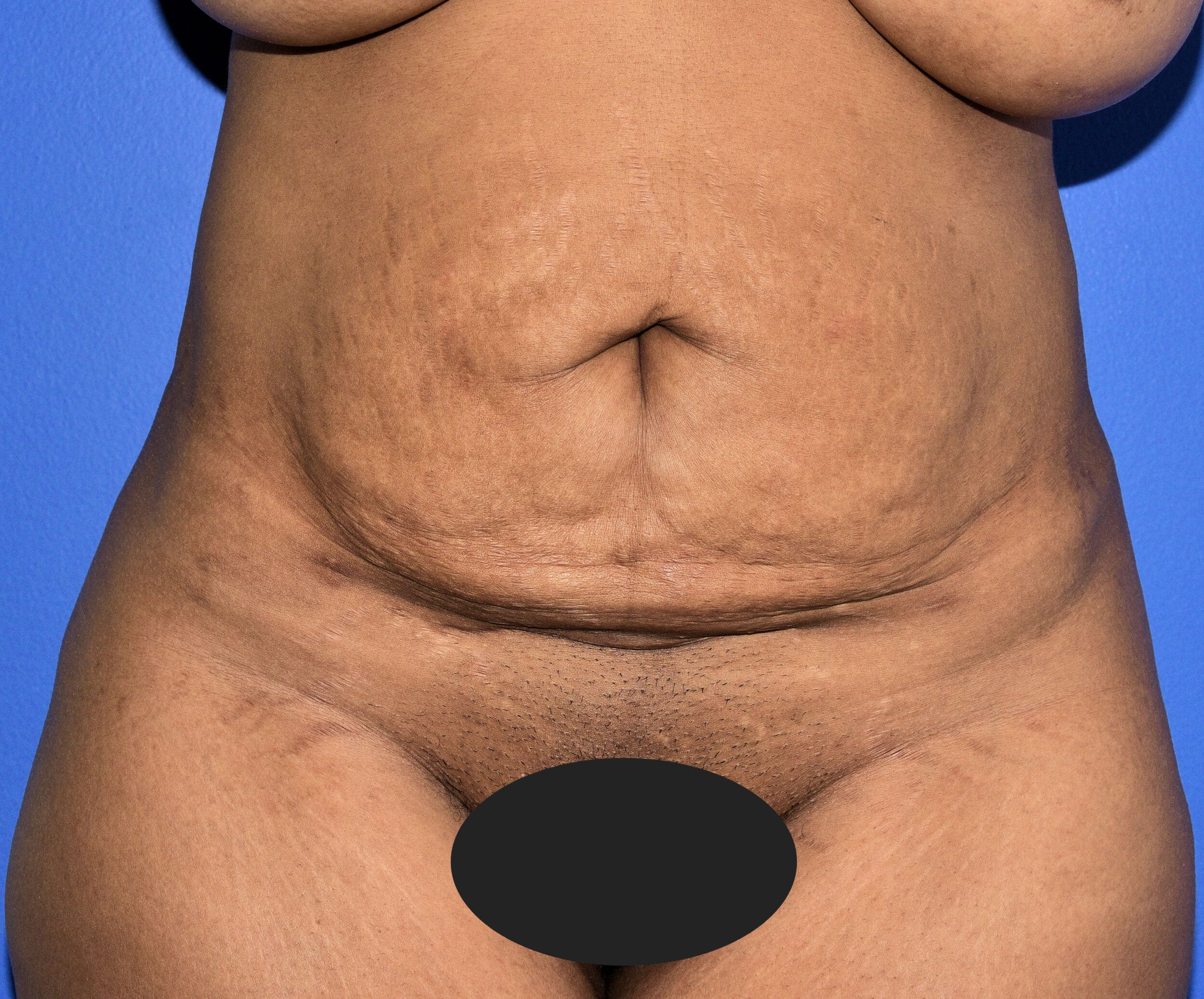 Before Image: Tummy Tuck After Abdominal Liposuction - front