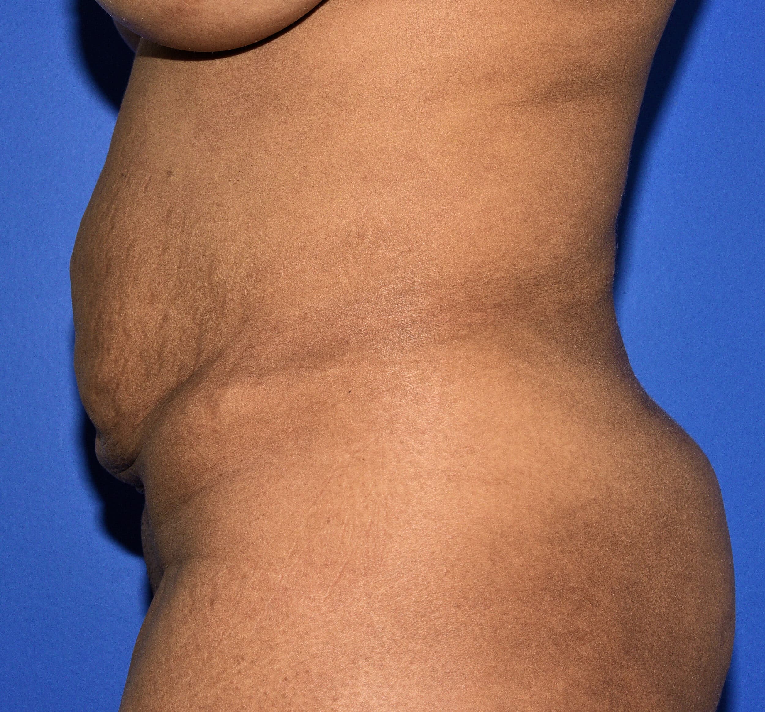 Before Image: Tummy Tuck After Abdominal Liposuction - left-side