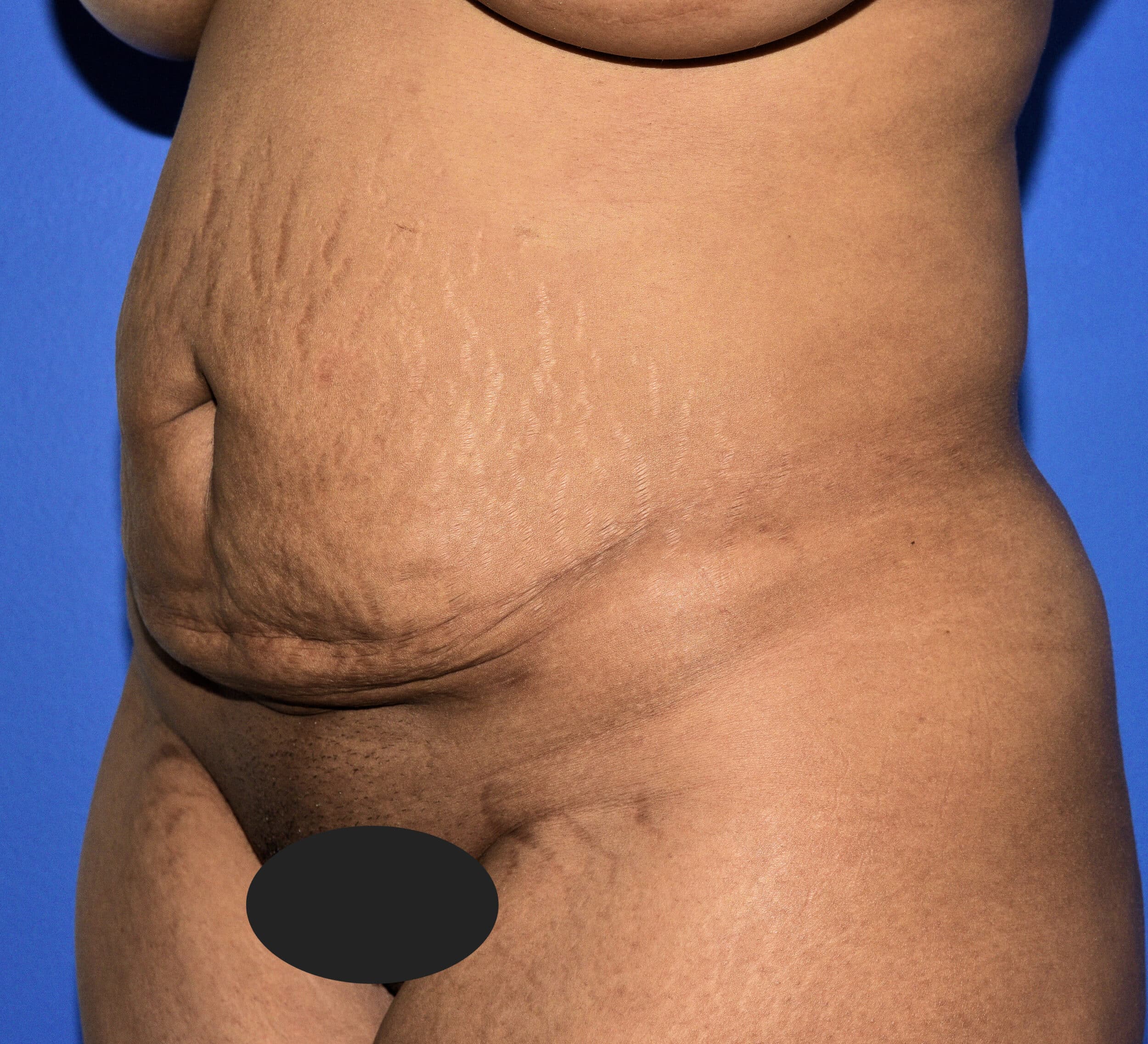 Before Image: Tummy Tuck After Abdominal Liposuction - left-front-oblique