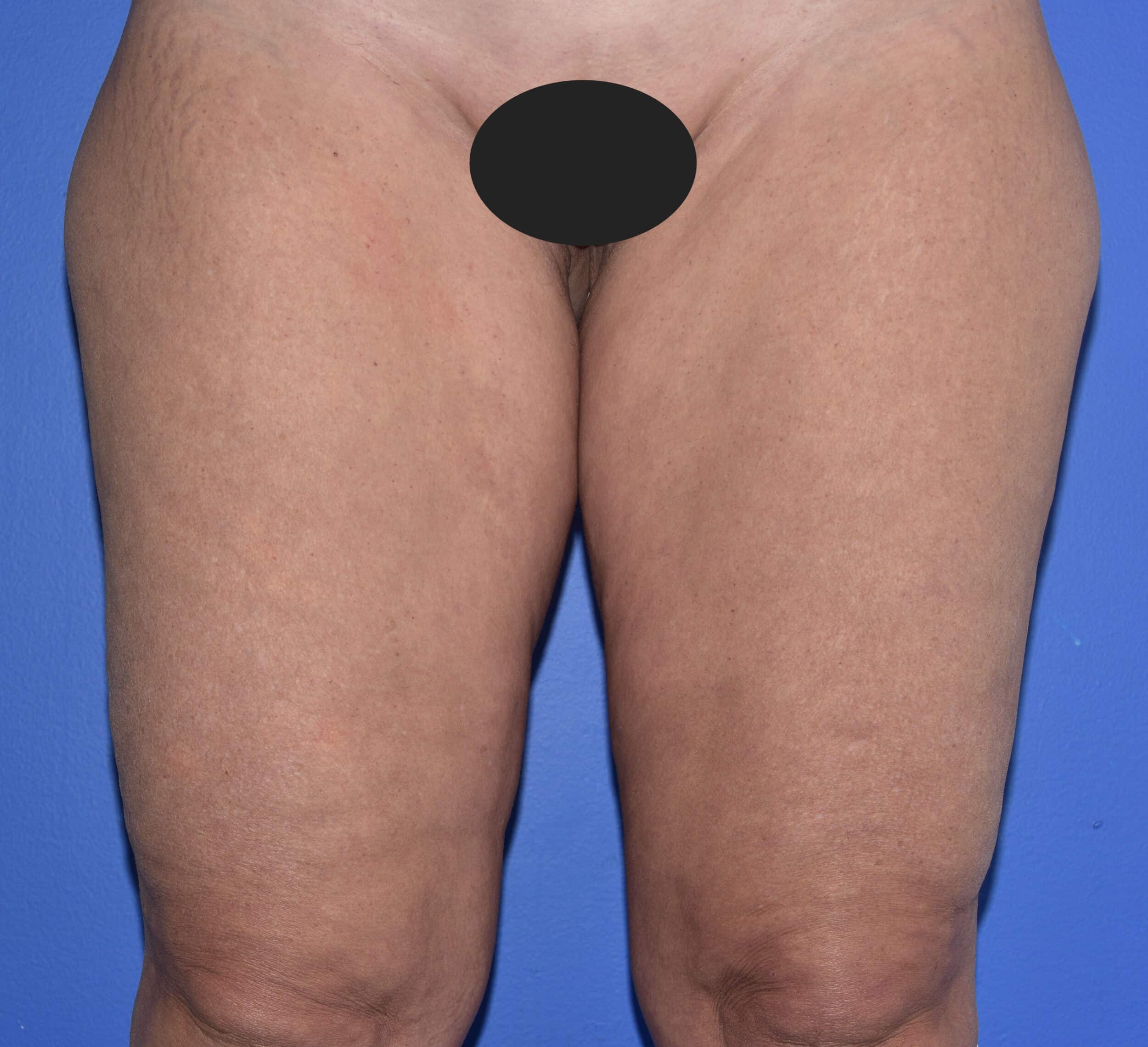 Before Image: Thigh Lift - front